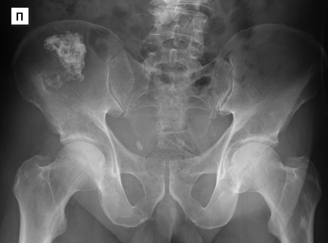 Образование подвздошной кости. Эностоз подвздошной кости рентген. Эностоз костей таза рентген. Метастазы костей таза рентген. Остеосклероз подвздошной кости кт.