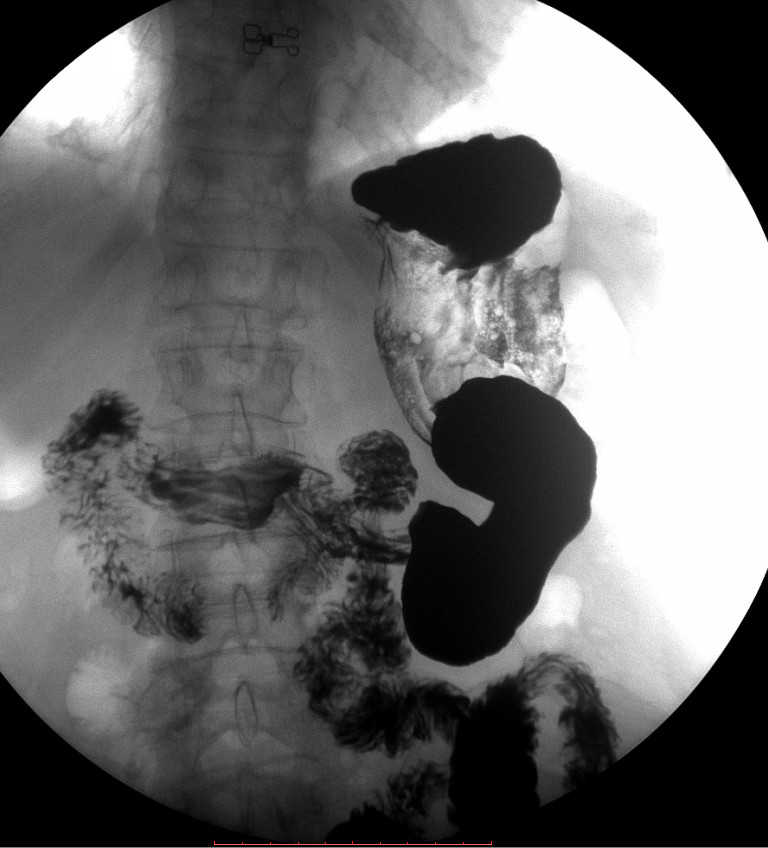 12 снимок. Дивертикул 12 перстной кишки рентген. Дивертикул двенадцатиперстной кишки рентген. Дивертикул желудка рентген. Дивертикул ДПК рентген.
