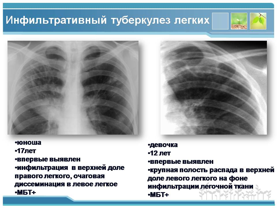 Инфильтративный туберкулез верхних долей легких. Инфильтративный туберкулез s6. Инфильтративный туберкулез рентген. Инфильтративная пневмония рентген. Инфильтративный туберкулез Лобит рентген.
