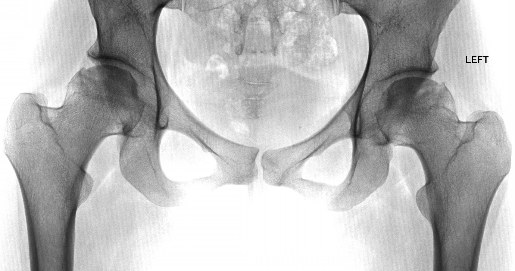 Некроз шейки бедра. АНГБК тазобедренных суставов что это. Асептический некроз тазобедренного сустава рентген. Асептический некроз тазобедренного кости. Некроз головки тазобедренного сустава на рентгене.