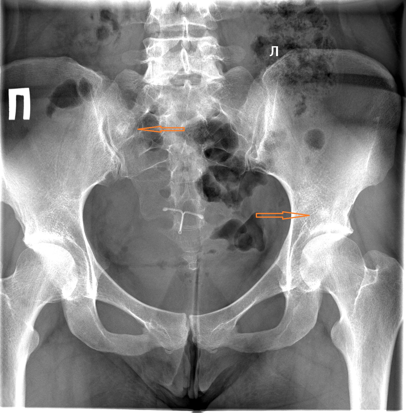 Кт подвздошной кости. Сакроилеит тазобедренного сустава на рентгене. Остеобластические метастазы в кости таза рентген.