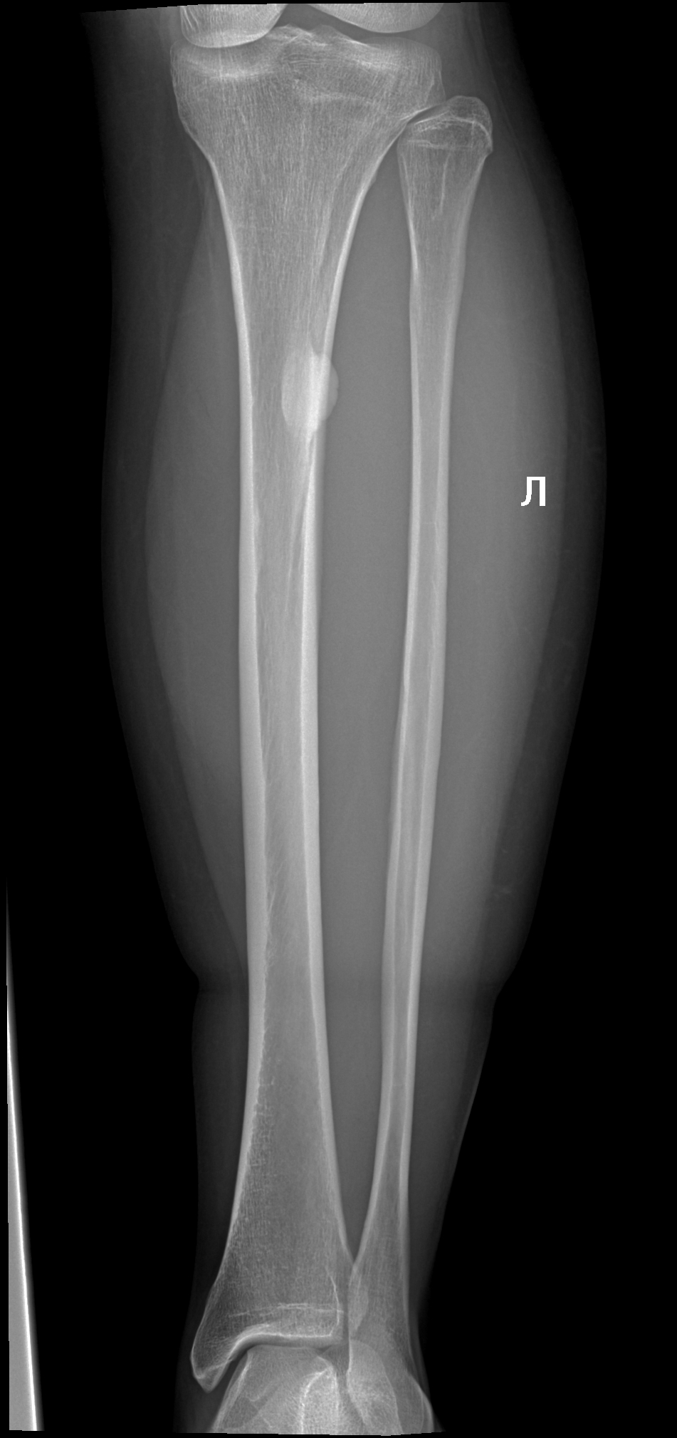 Большеберцовая кость рентген