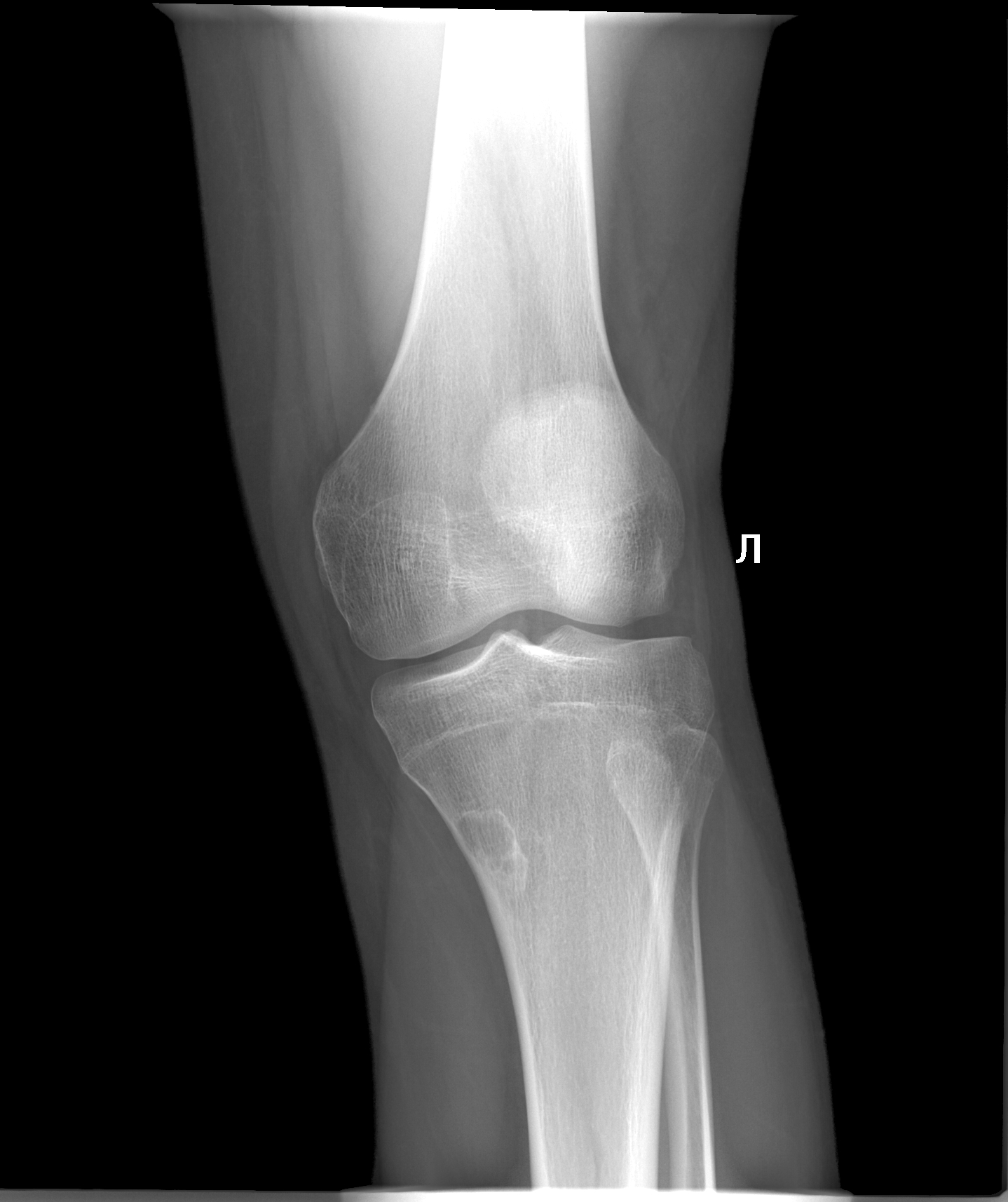 Фото коленного. Рентген снимок коленного сустава в норме. Рентген здорового коленного сустава. Коленный сустав рентген норма. Рентгенограмма здорового коленного сустава.