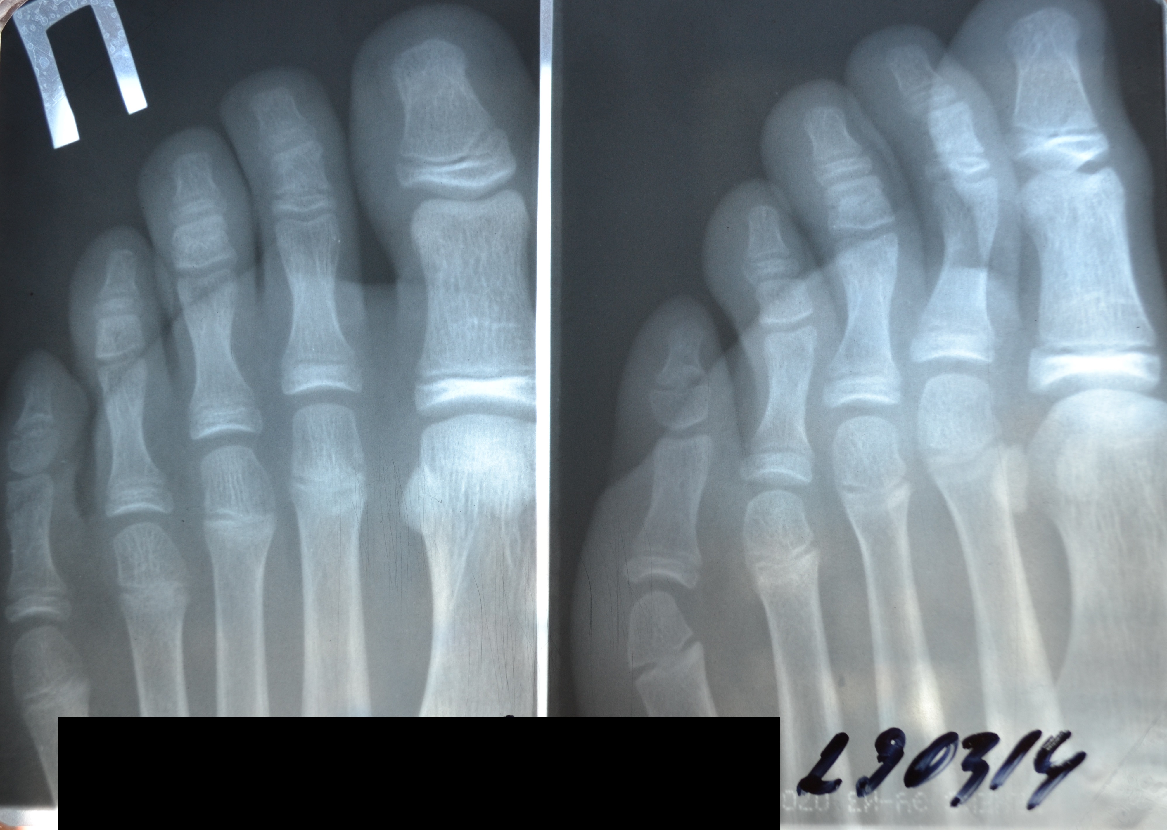 Ногтевая фаланга ноги. Рентген перелома дистальной фаланги 1 пальца. Перелом проксимальной фаланги 2 пальца. Закрытый перелом основной фаланги 1 пальца стопы рентген. Краевой перелом средней фаланги 5 пальца.
