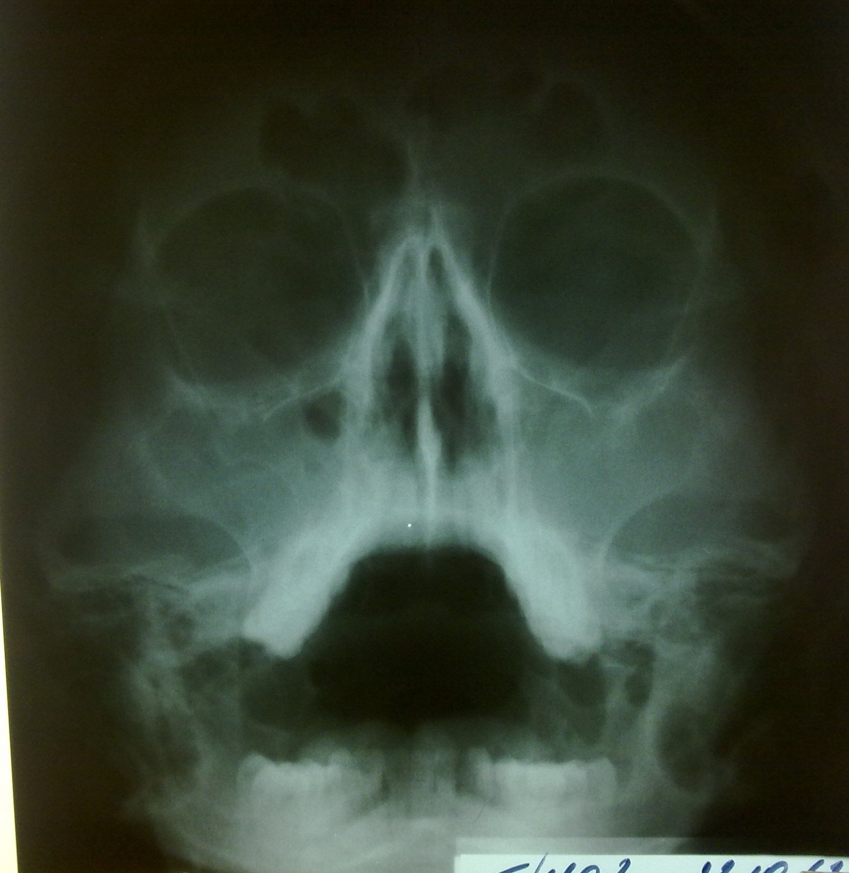 Кривая носовая перегородка рентген