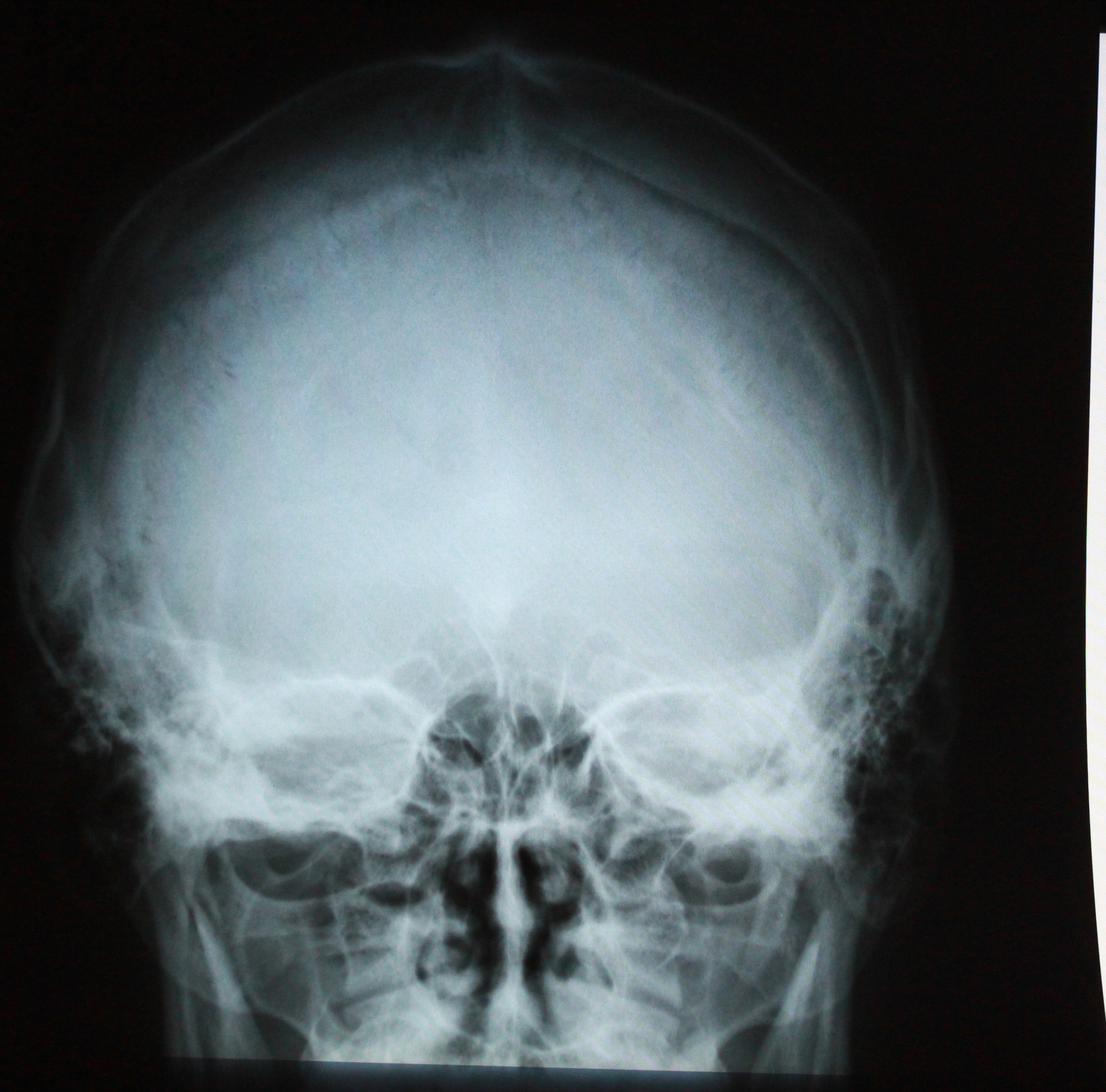 Сотрясение черепа. Рентген черепа сотрясение мозга. Сотрясение головного мозга рентген снимок. Рентгеновский снимок головы. Рентгеновский снимок черепа.