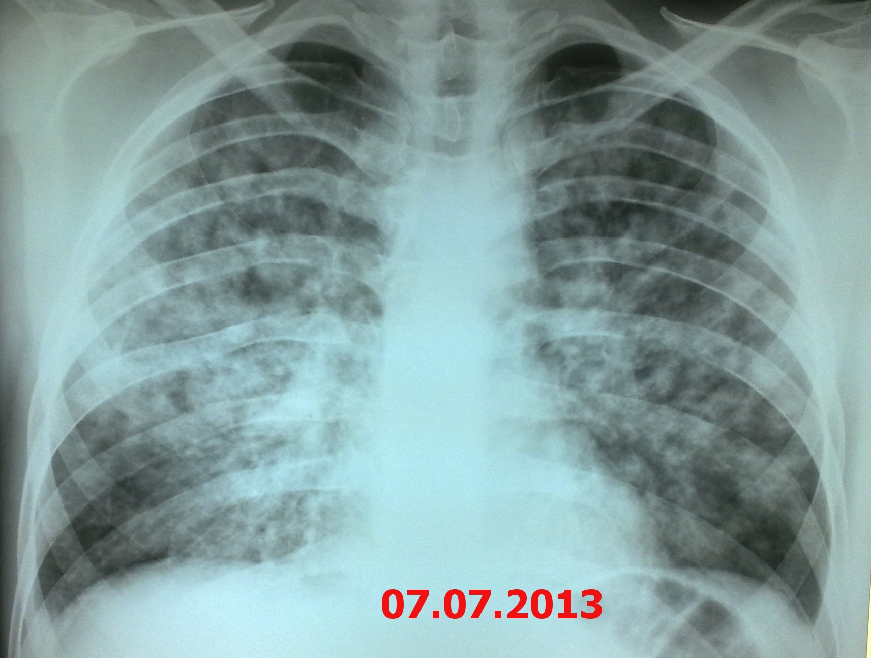 Туберкулез легких в фазе инфильтрации. Милиарный диссеминированный туберкулез. Острый диссеминированный туберкулез рентген. Диссеминация туберкулеза. Диссеминированный туберкулёз лёгких рентген.