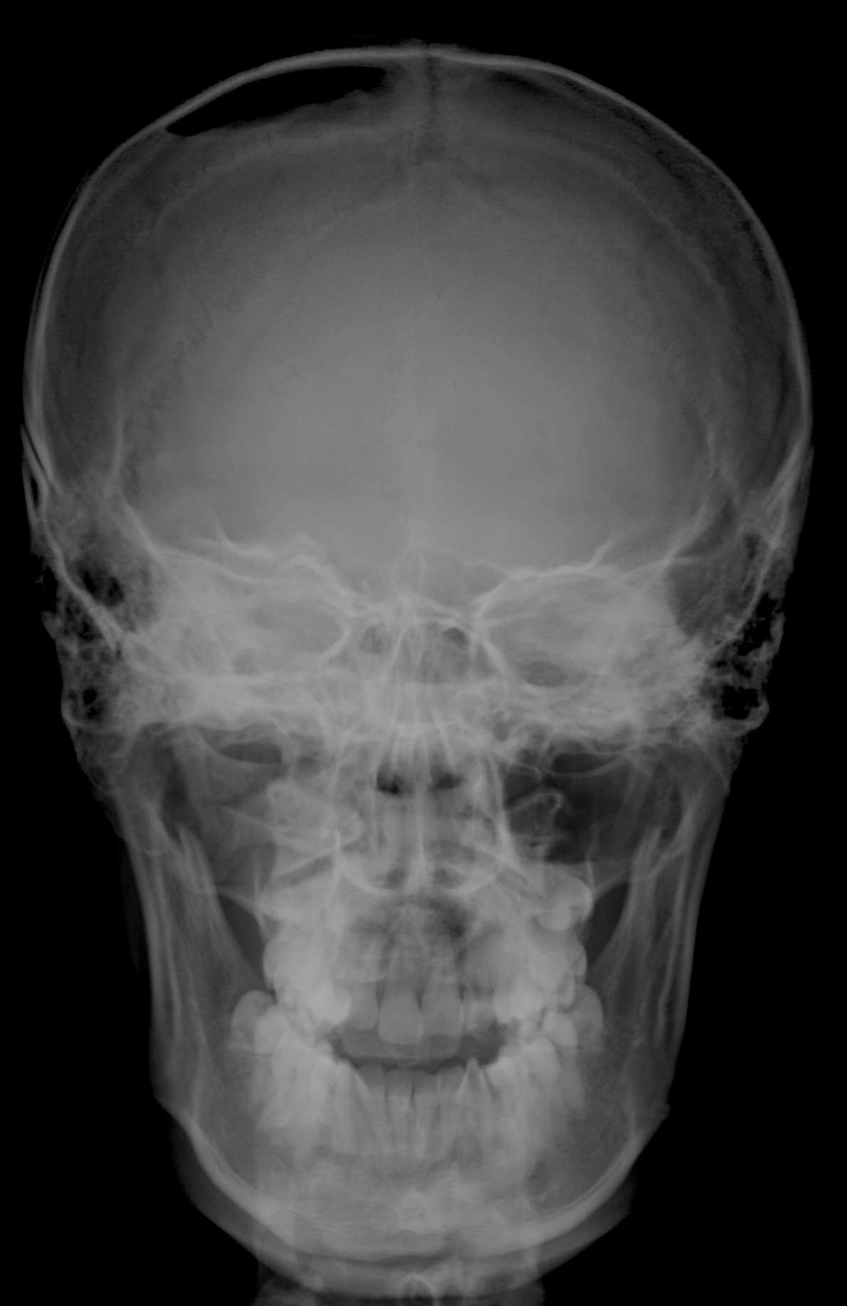 Перелом лицевого черепа. Пневмоцефалия рентген. Перелом лицевой кости черепа. Рентген черепа патология.