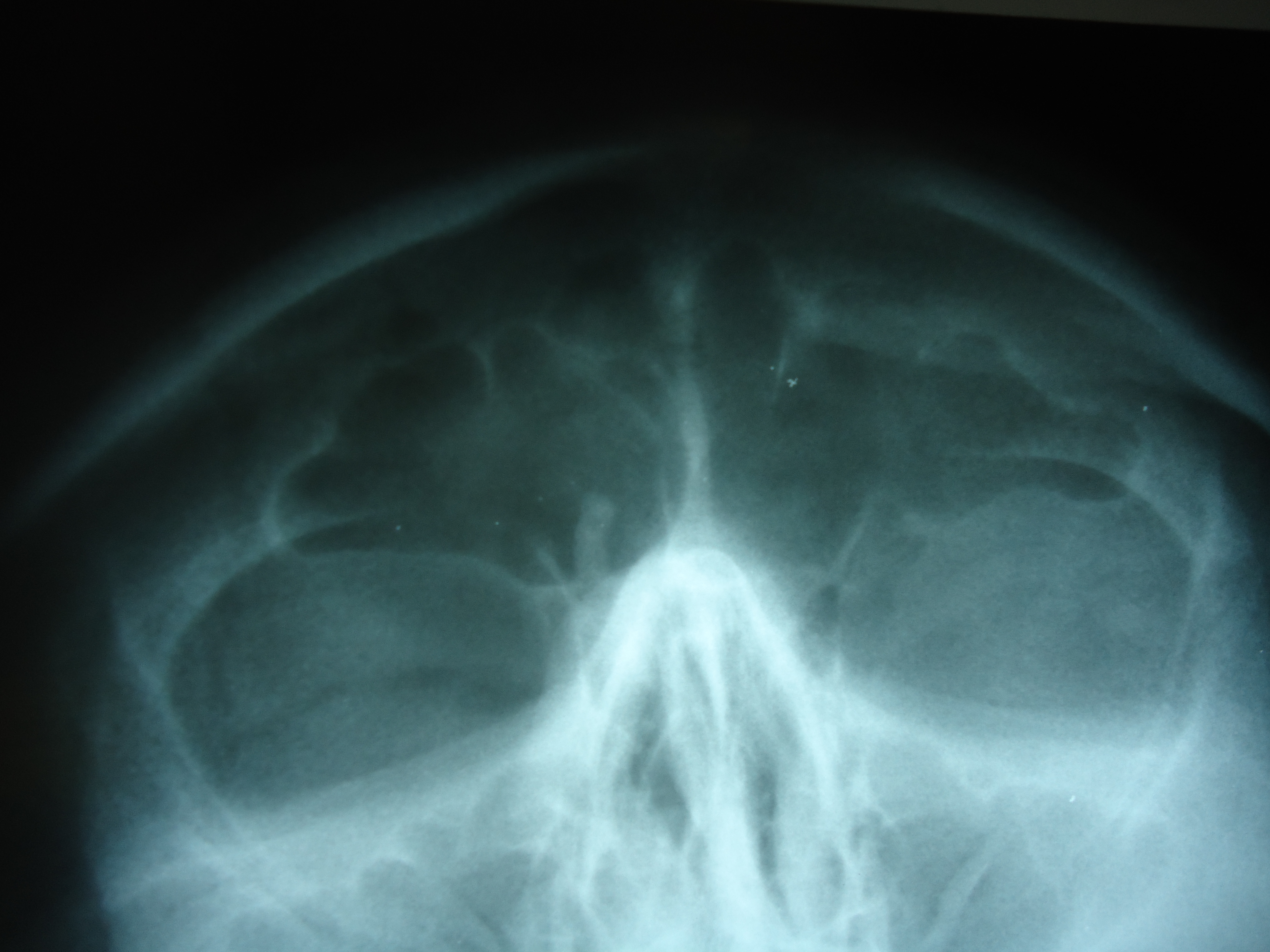 Остеома придаточных пазух носа рентген