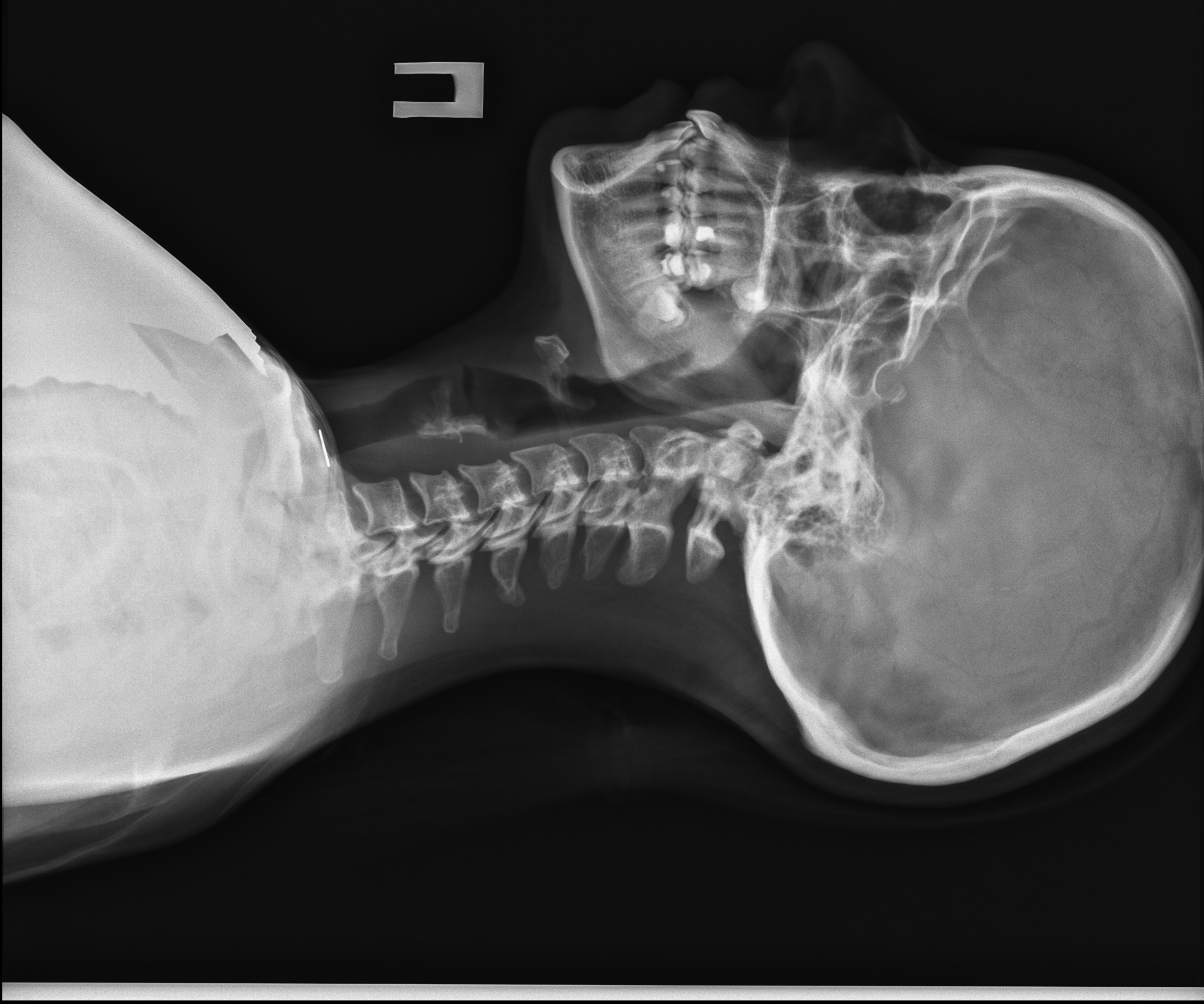 Снимок 5. Перелом остистого отростка c7. Перелом 2 шейного позвонка рентген. Рентген шеи перелом остистого отростка позвонка с1. Перелом 6 позвонка шеи рентген.