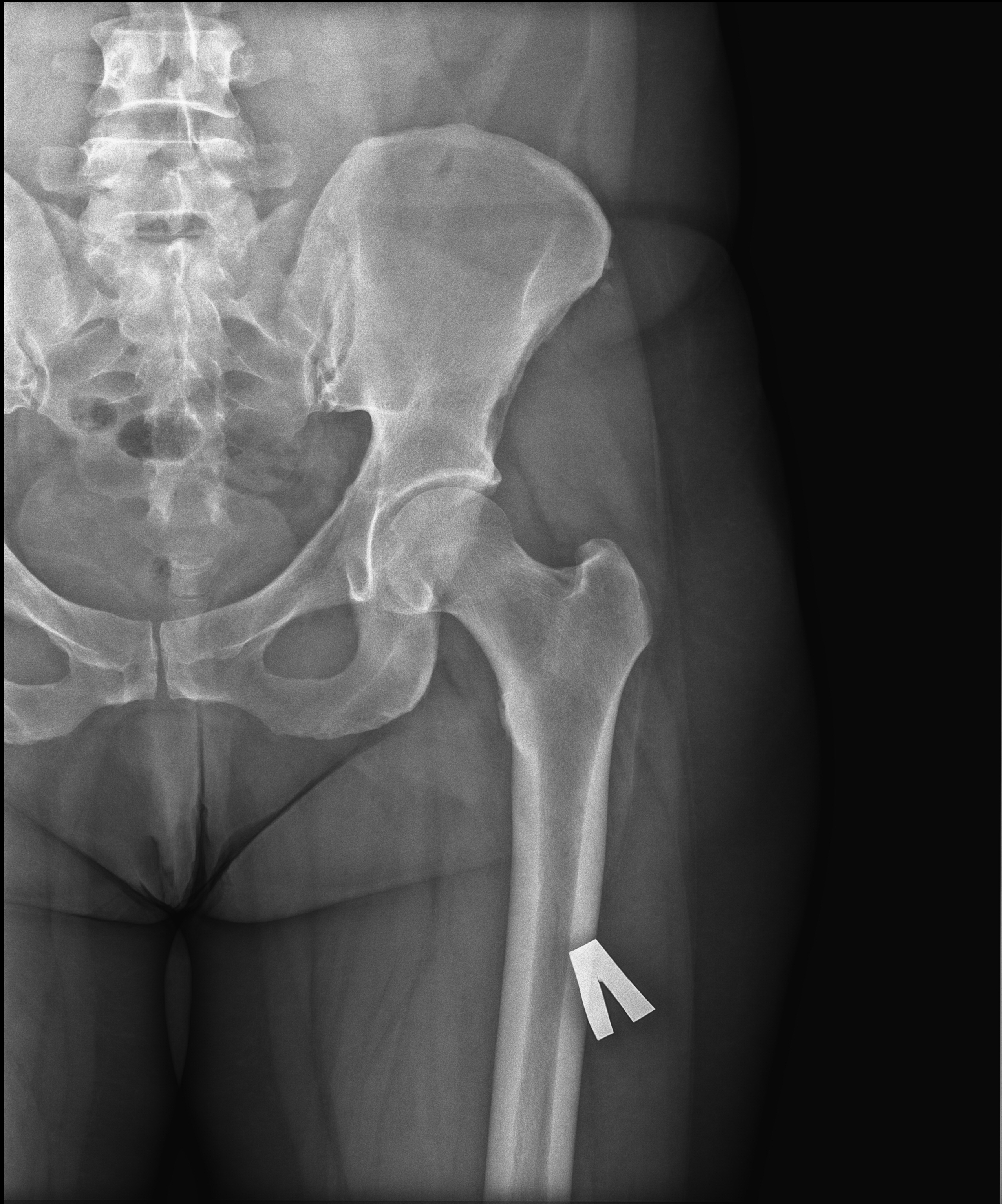 Образование подвздошной кости. Остеосклероз тазобедренного сустава рентген. Рентген подвздошной кости. Киста подвздошной кости рентген. Апофизеолиз крыла подвздошной кости.