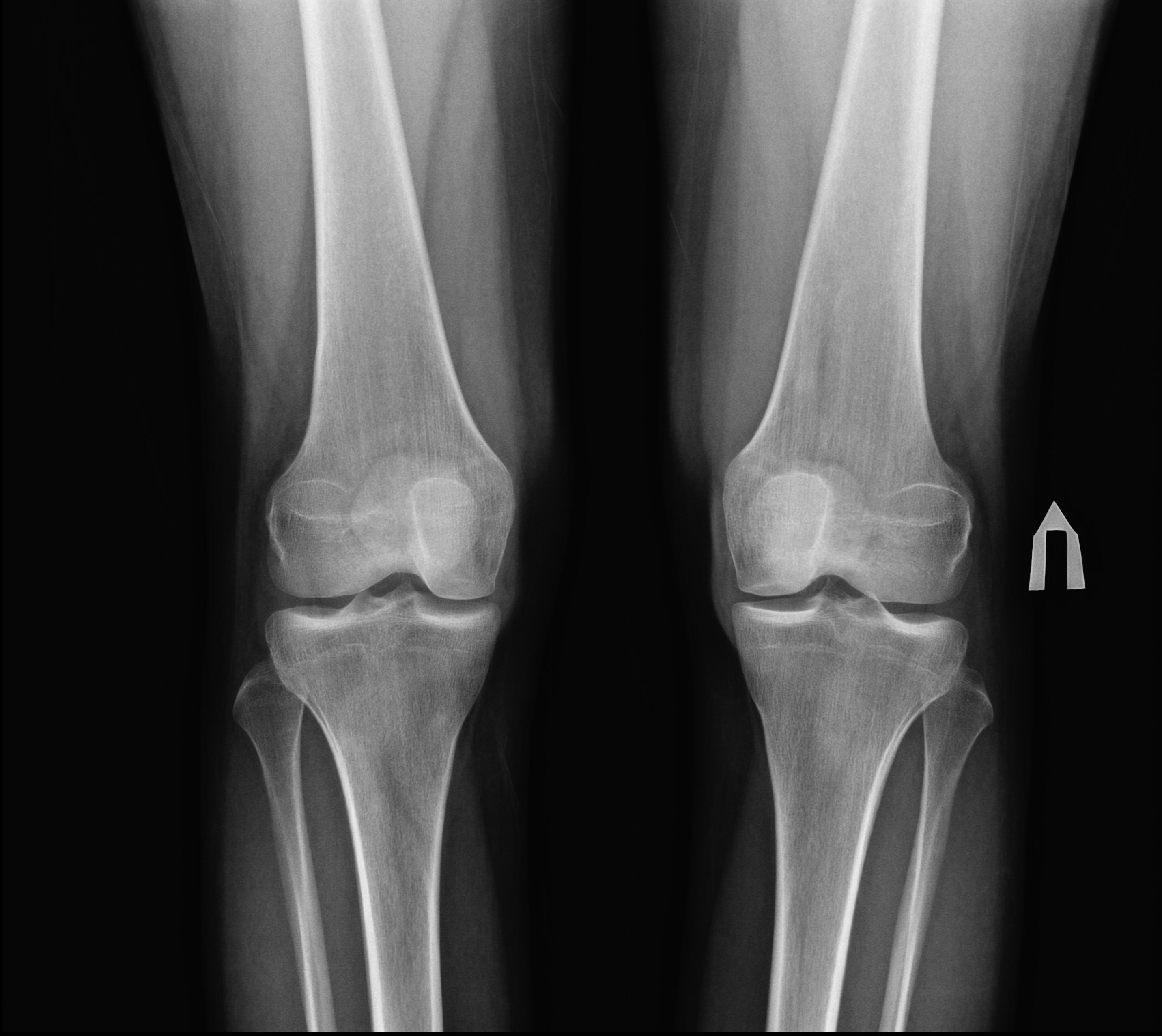 Лигаментоз крестообразных связок коленных. Суставная мышь коленного сустава рентген. Суставные мыши в коленном суставе рентген. Внутрисуставная мышь коленного сустава рентген. Лигаментоз коленного сустава рентген.
