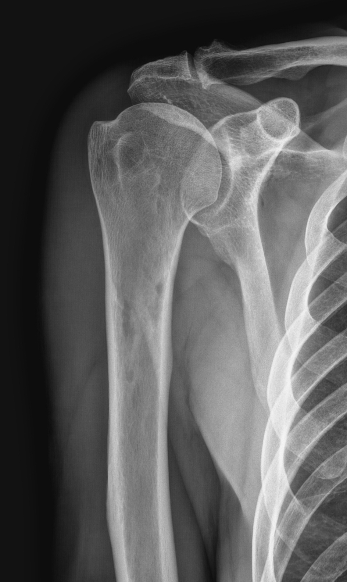 плечевая кость фото анатомия