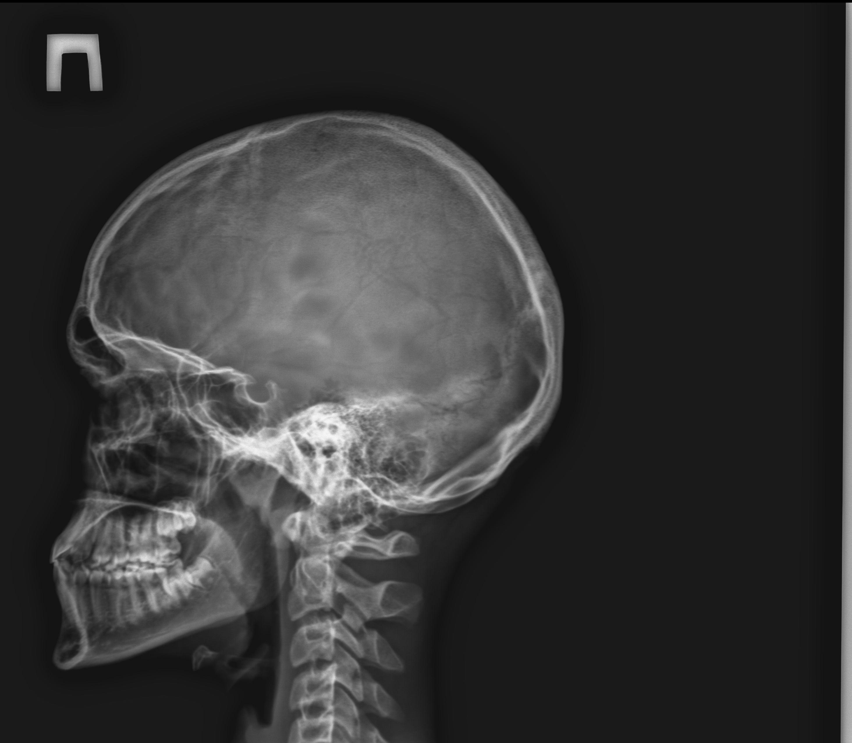 Детский череп рентген. Остеома затылочной кости черепа рентген. Ахондроплазия рентген черепа. Остеома костей черепа рентген. Рентген затылочной кости.