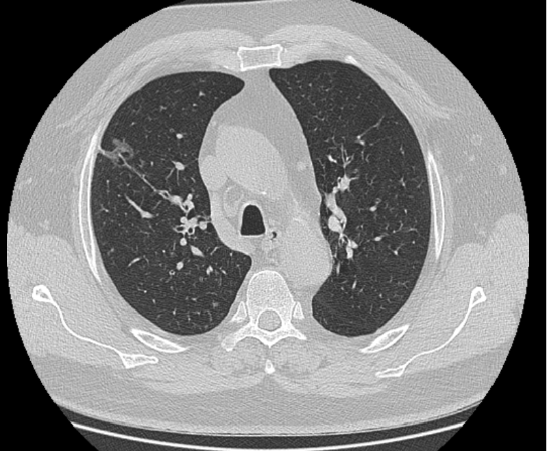 Пневмония на кт ОГК. Кт рентгенография ОГК. ИФЛ ОГК кт. Кт органов брюшной полости грудной клетки