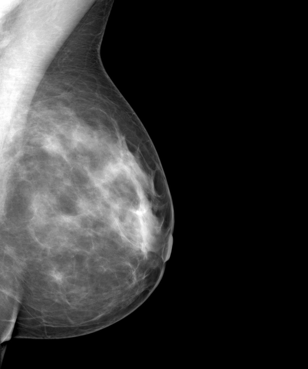 рак молочной железы 4 стадия фото