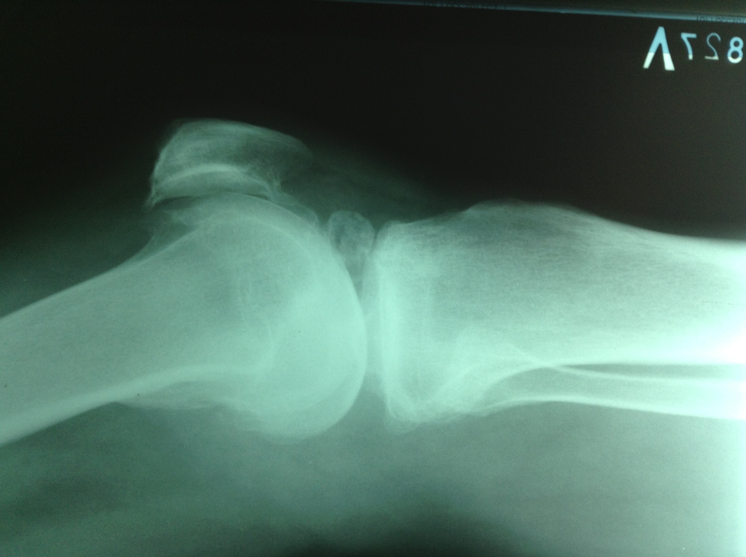 Хондроматоз коленного сустава что это такое и лечение фото