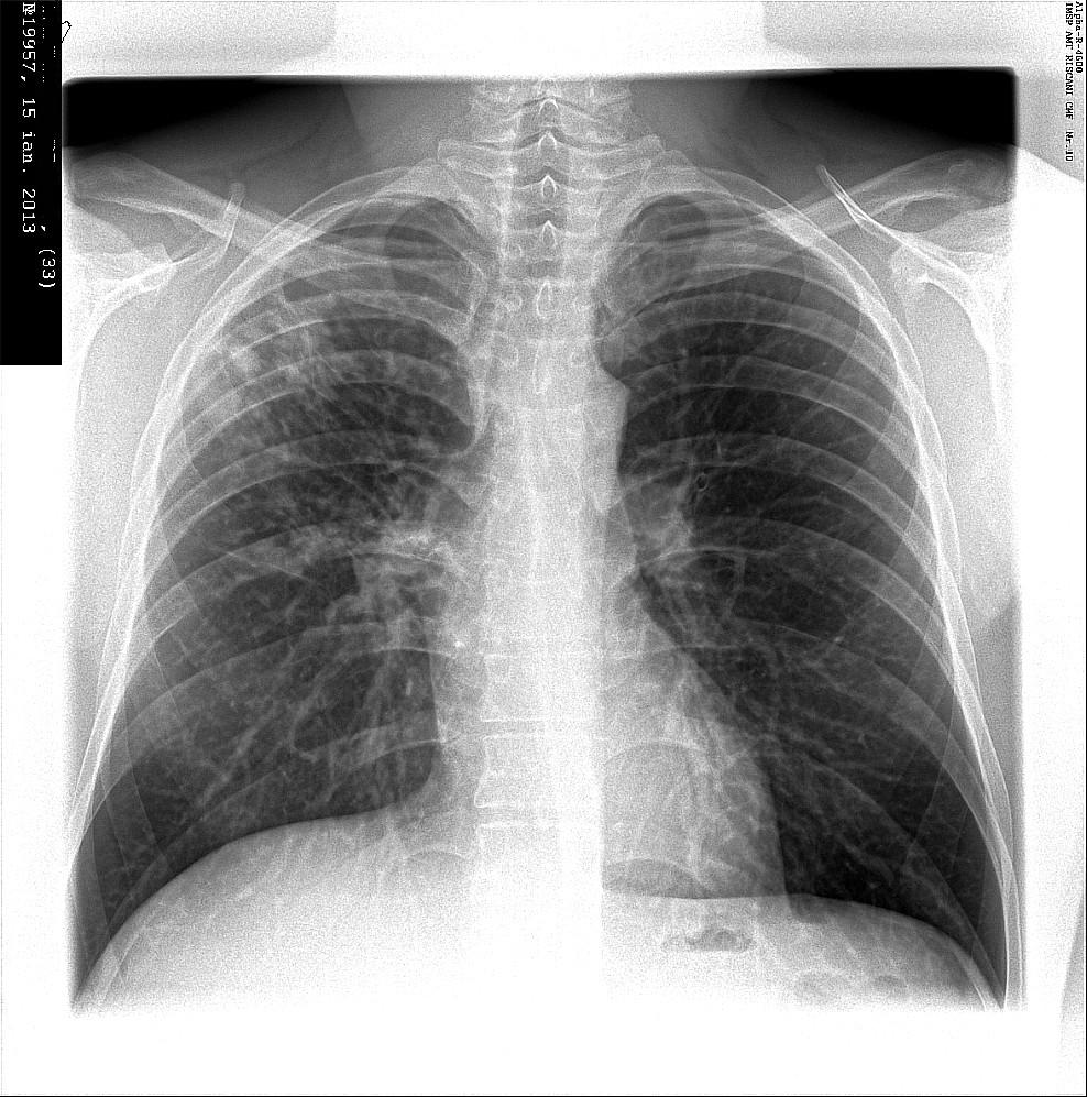 Как выглядят легкие при туберкулезе фото