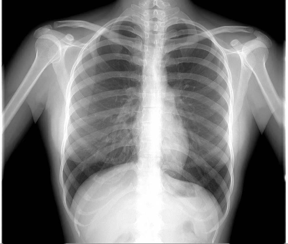 Перелом ребра на рентгене фото