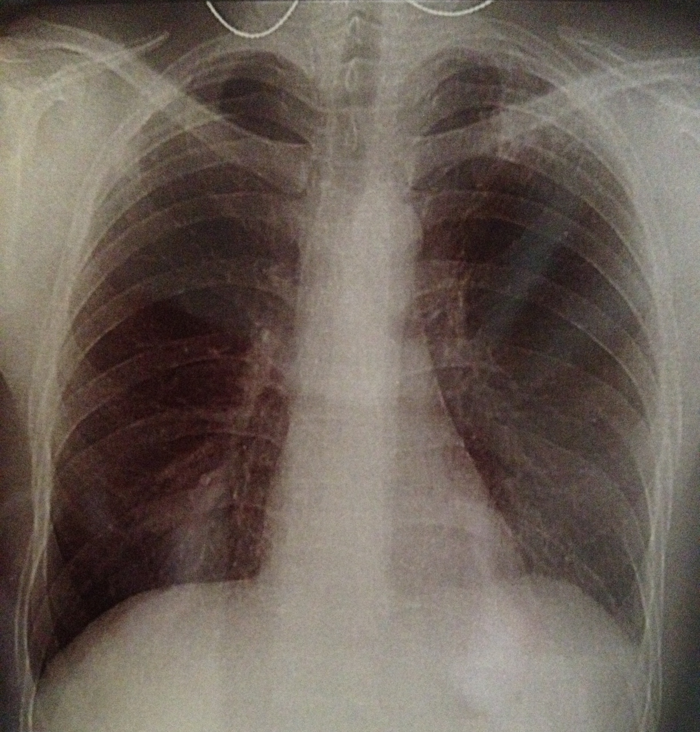 Инфильтративный туберкулёз лёгких рентген