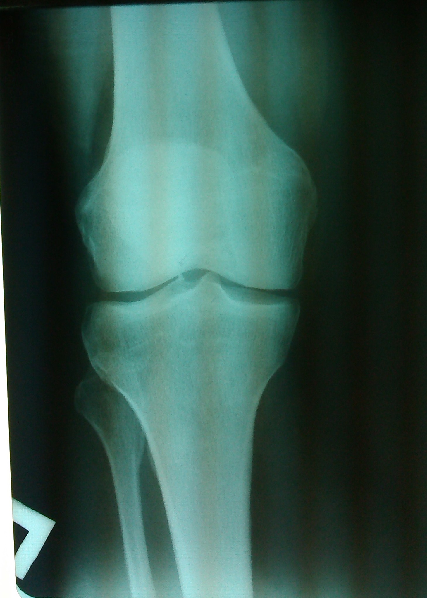 Трещина в коленной. Болезнь Гоффа коленного сустава рентген. Здоровый коленный сустав рентгеновский снимок. Рентген колена с переде. Рентген здорового коленного сустава.