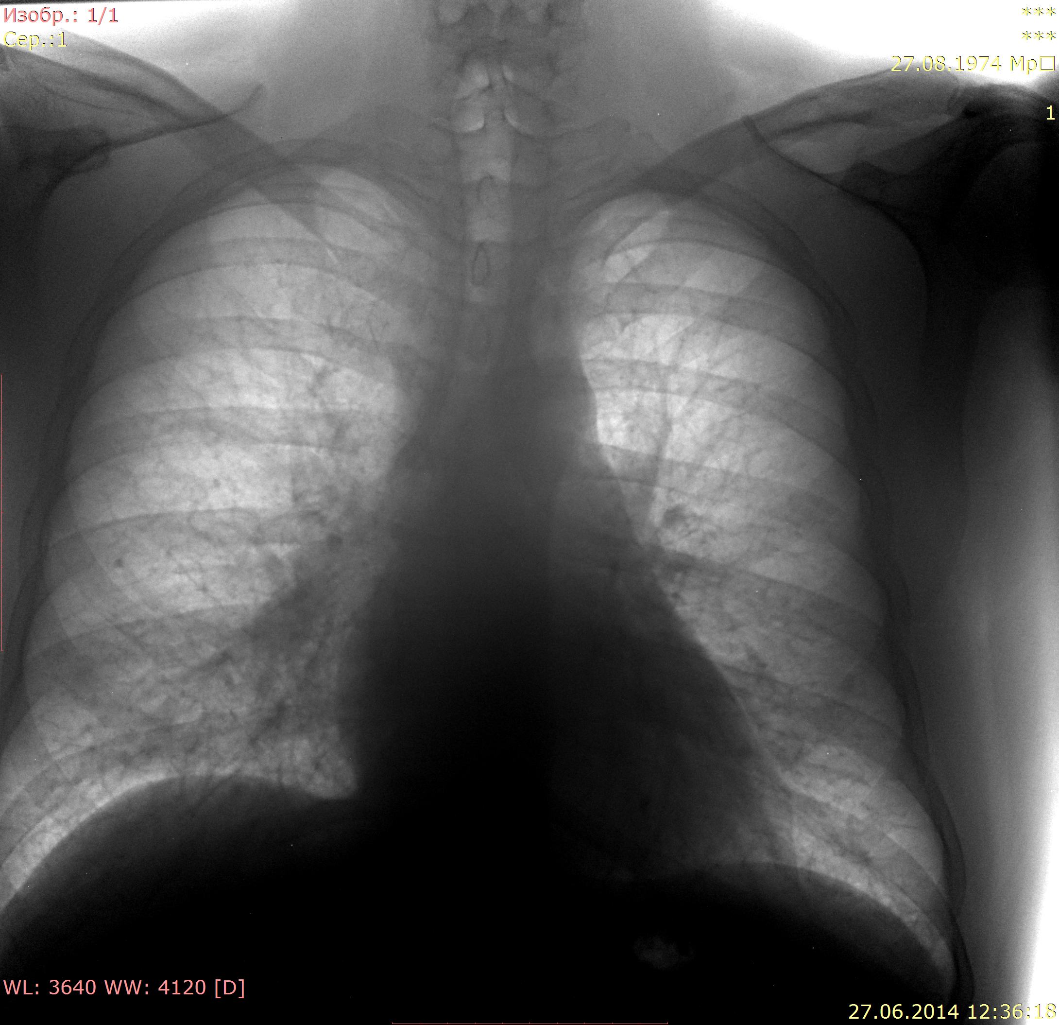 Флюорография легочный рисунок усилен