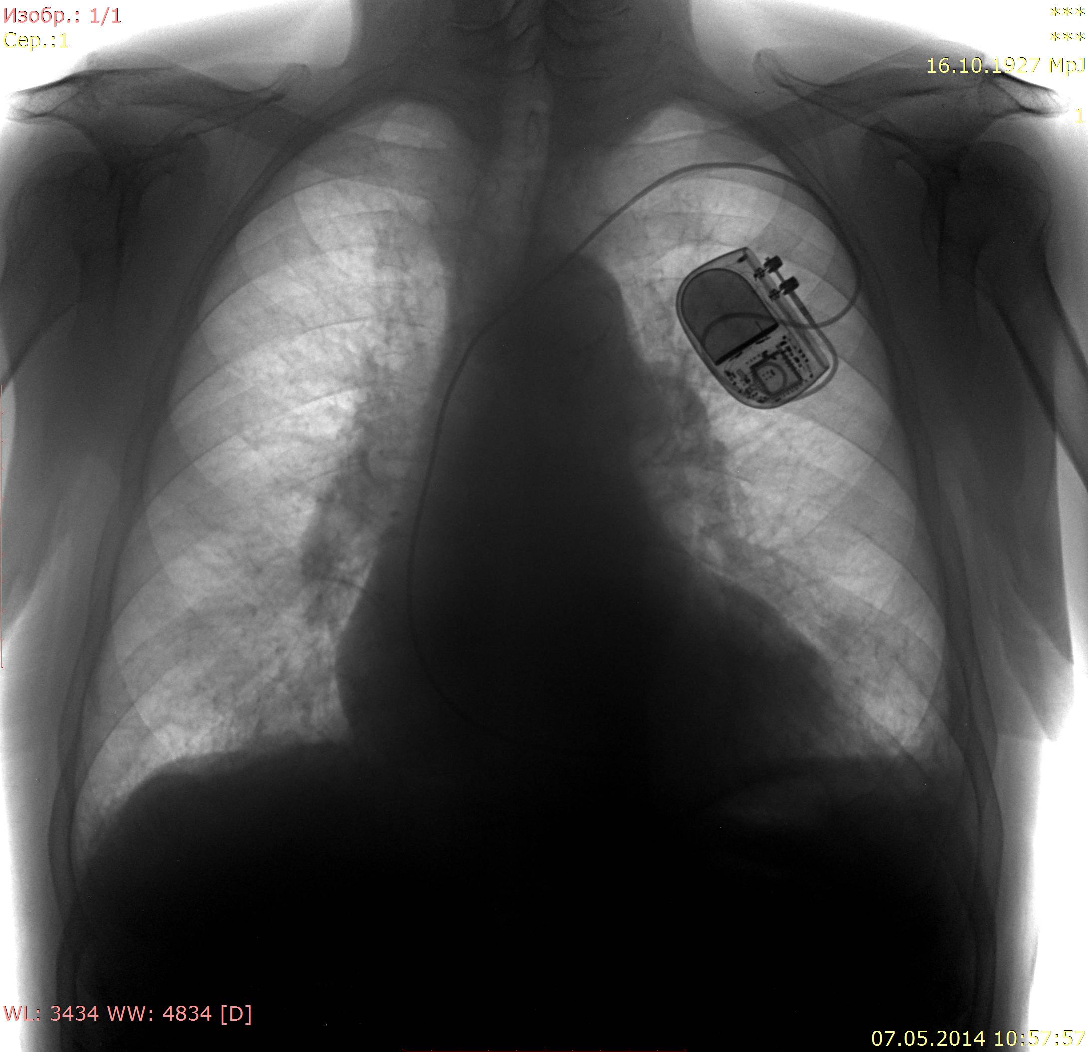 Черные точки на легких. Флюорография рентген легких курильщика. Снимки флюорографии легких.