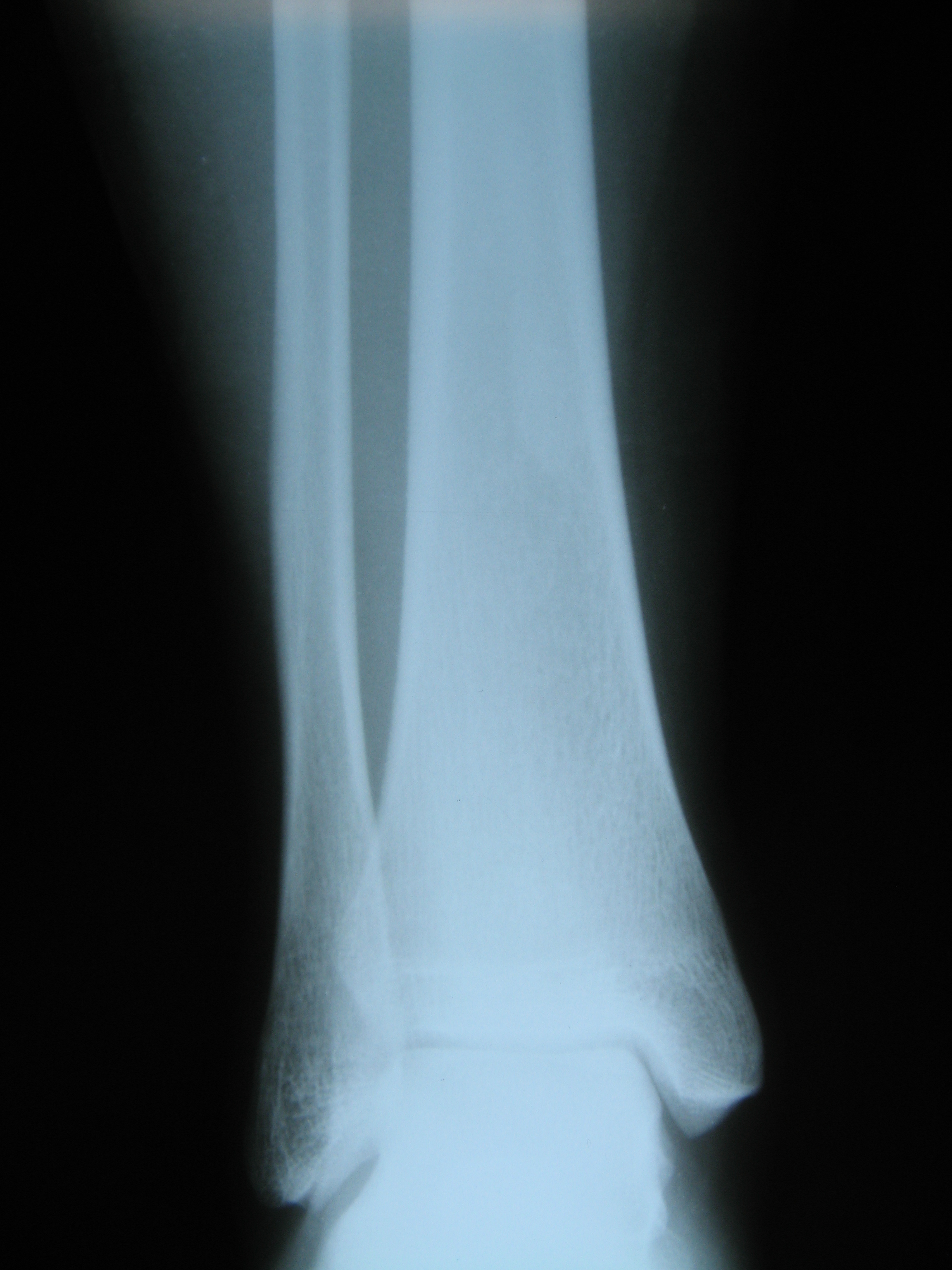 Остеосклероз берцовой кости рентген