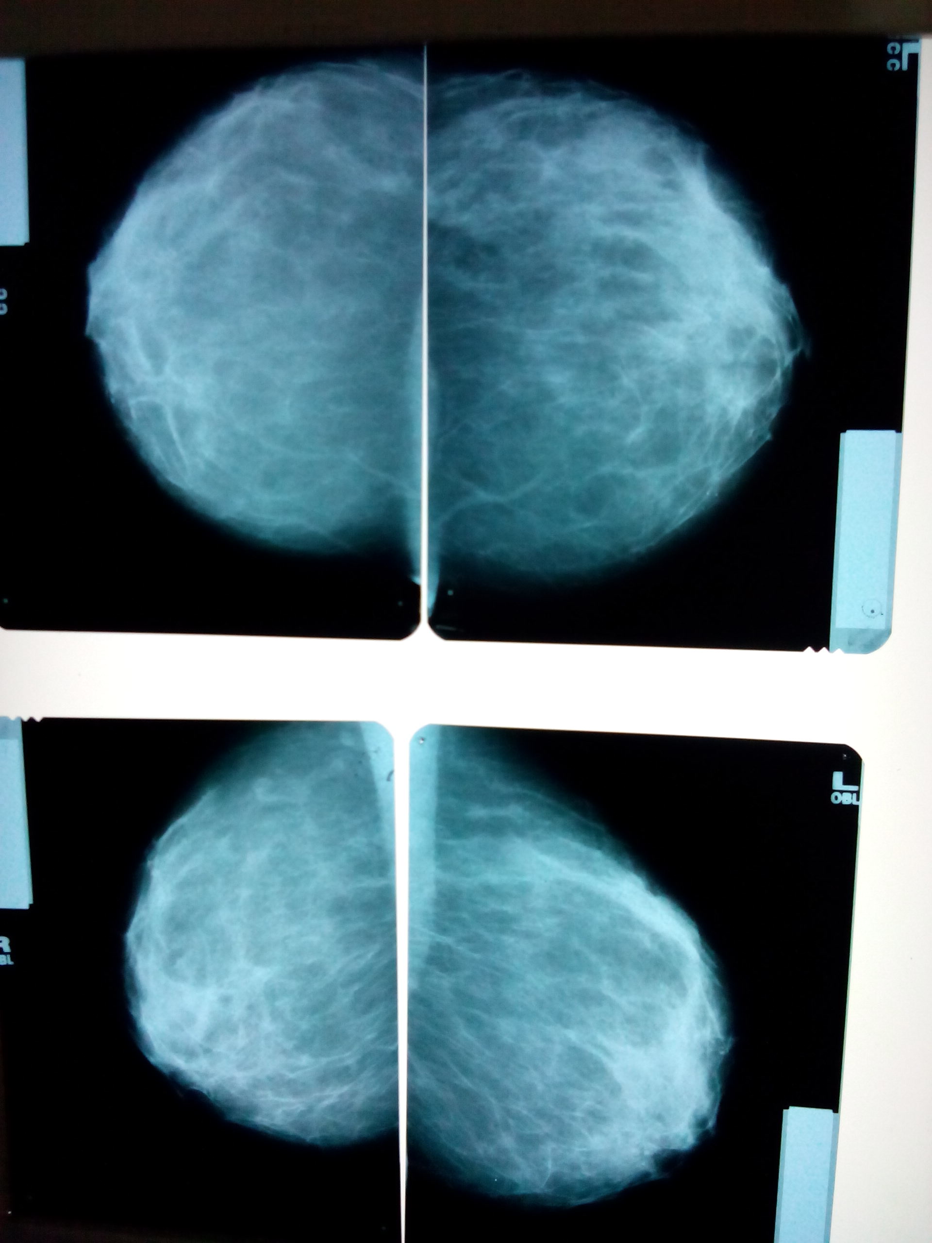 Маммография ростов на дону. ФКМ маммография рентген. Фиброзно-кистозная мастопатия маммография. Маммография рентген снимки. Фиброзно кистозная мастопатия маммограмма.