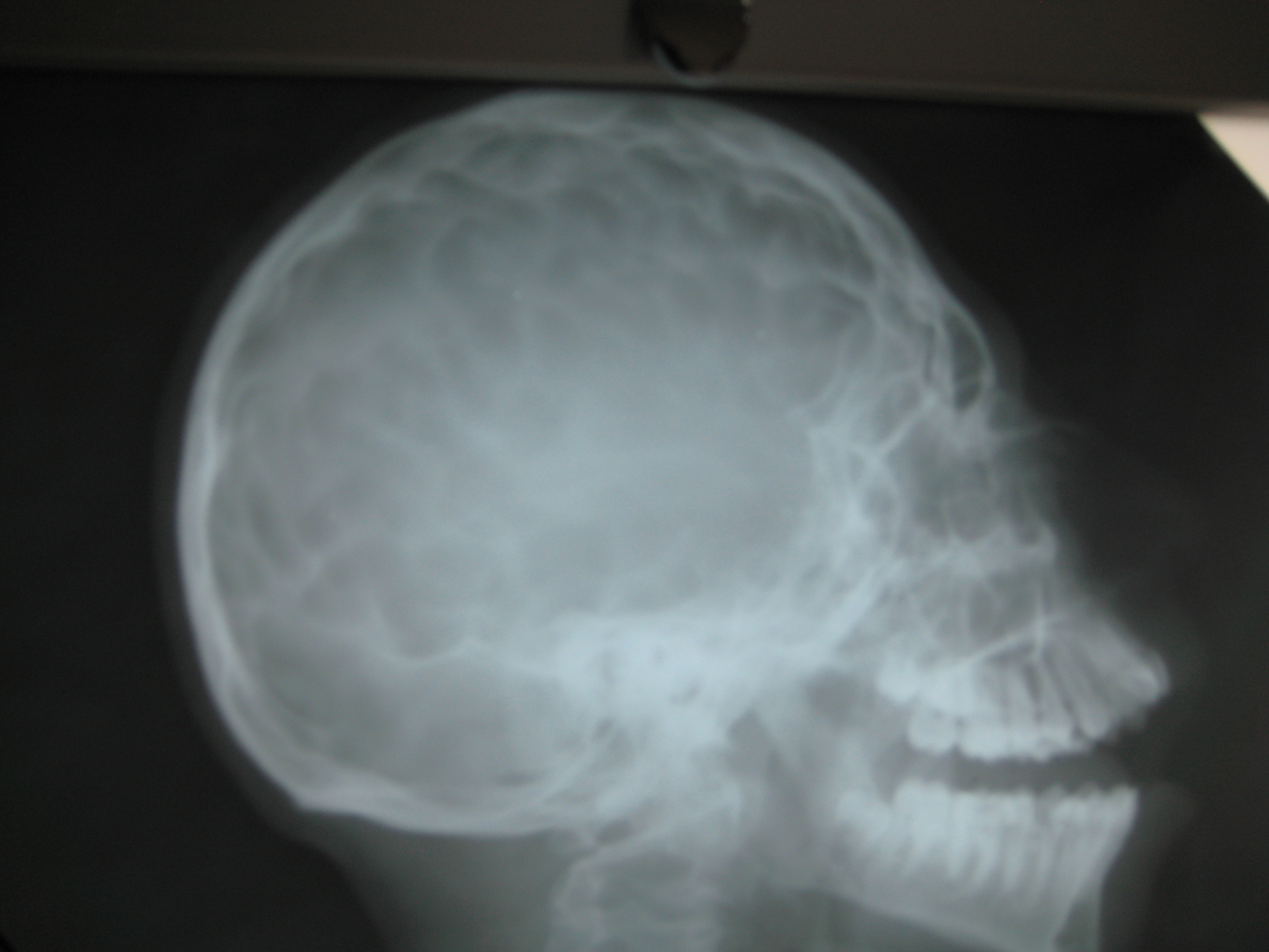Детский череп рентген. Краниостеноз рентген головы. Рентгенограмма черепа новорожденного. Рентген головы младенца.