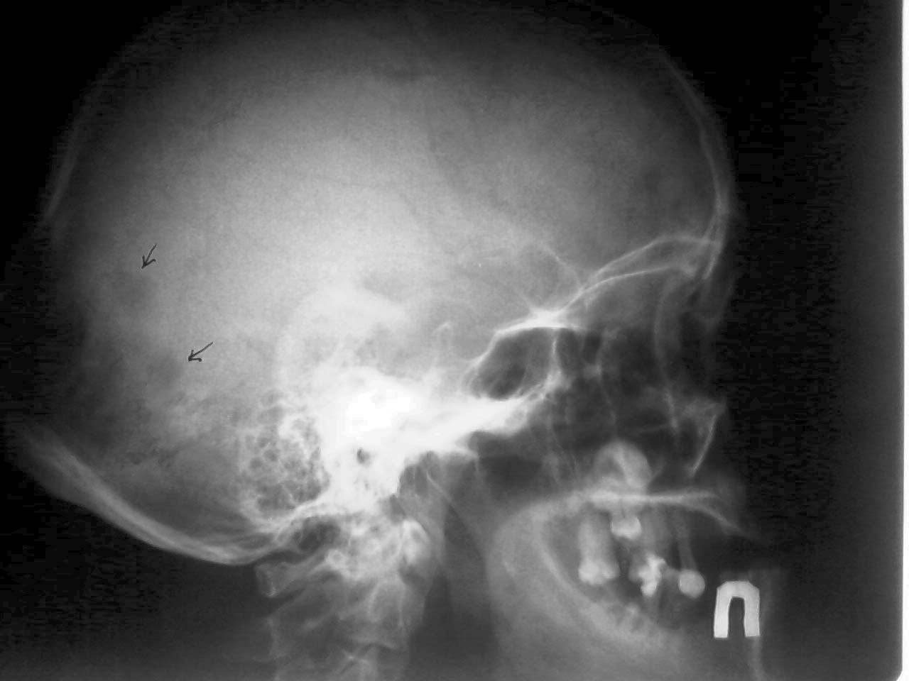 Норма костей черепа на рентгене