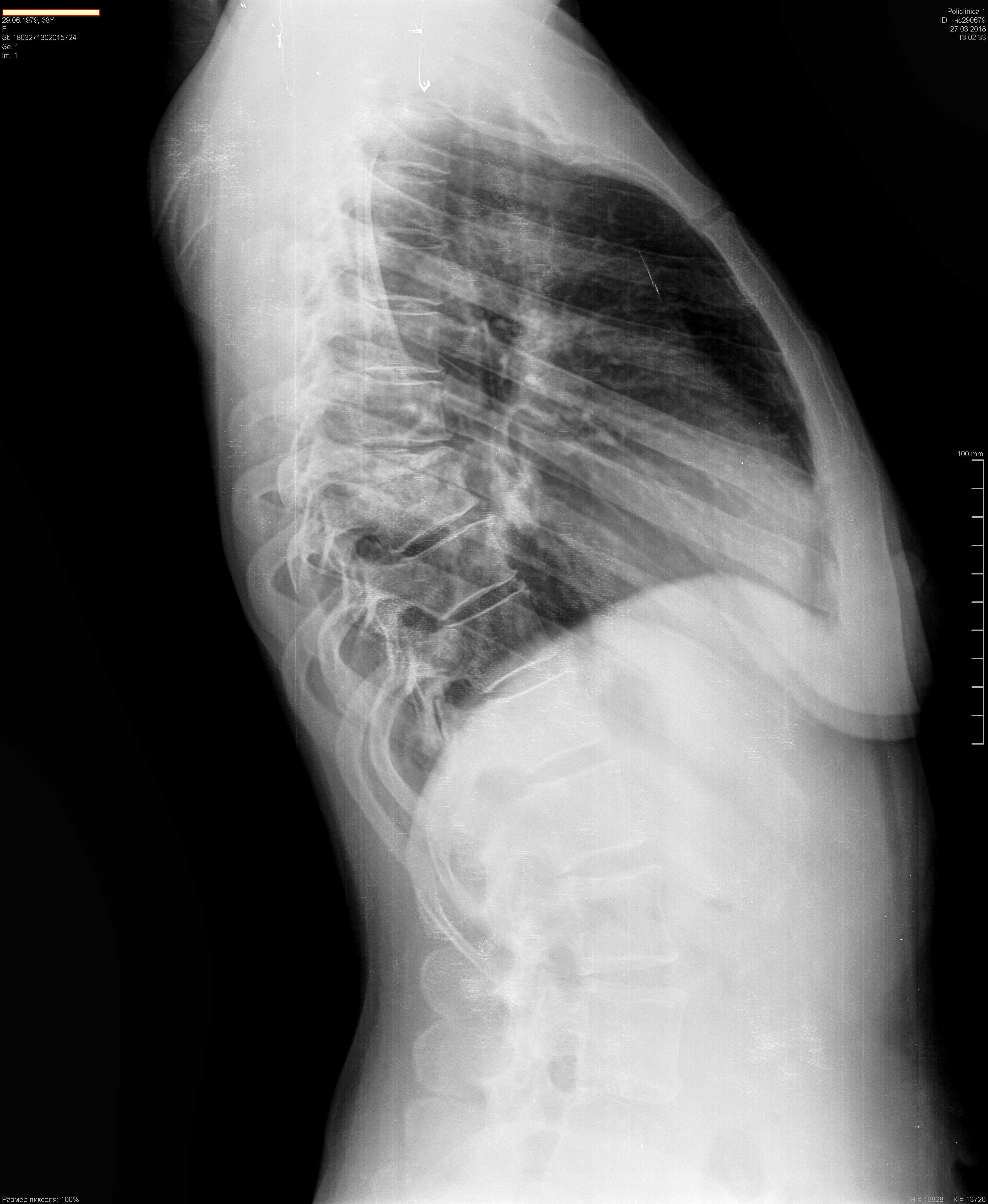 Рентгенография боковой проекции. Рентгенограмма грудного отдела позвоночника в боковой проекции. Рентген грудного отдела в боковой проекции. Рентгенограмма позвоночника в 2-х проекциях. Рентген грудного отдела в 2 проекциях.