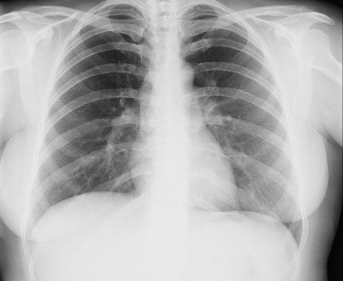 Организующая пневмония рентген