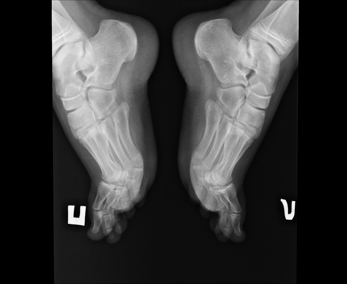 Болезнь келлера стопы. Остеохондропатия ладьевидной кости стопы рентген. Болезнь Келлера 1 рентген. Остеохондропатия ладьевидной кости Келлер 1.