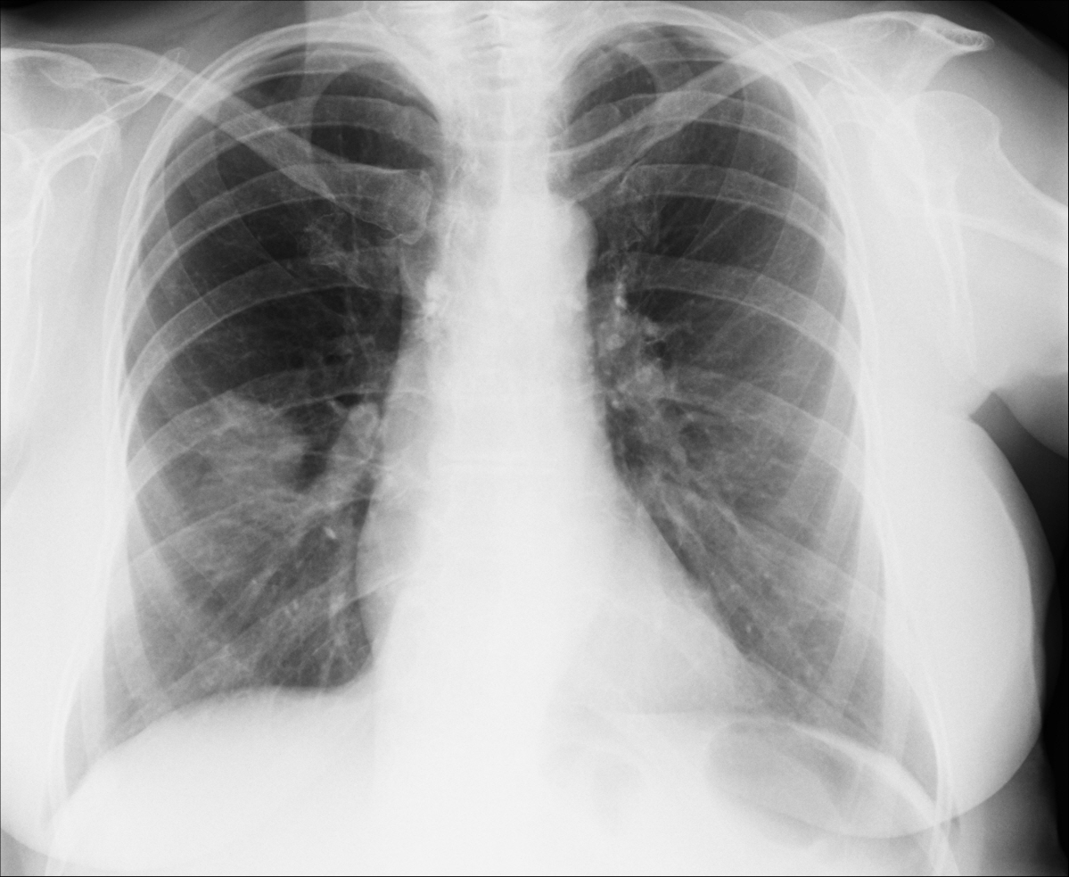 Стрептококковая пневмония рентген