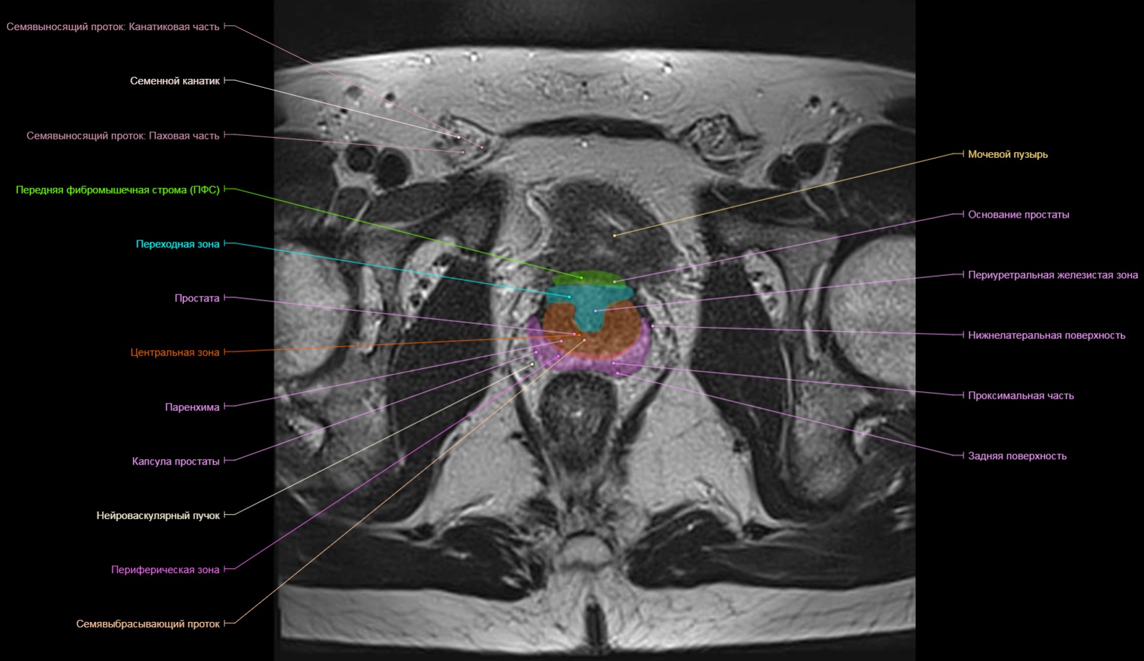 Транзиторная зона предстательной железы. Сегменты предстательной железы мрт. Анатомия предстательной железы мрт схема. Зональная анатомия предстательной железы мрт. Зональное строение предстательной железы мрт.