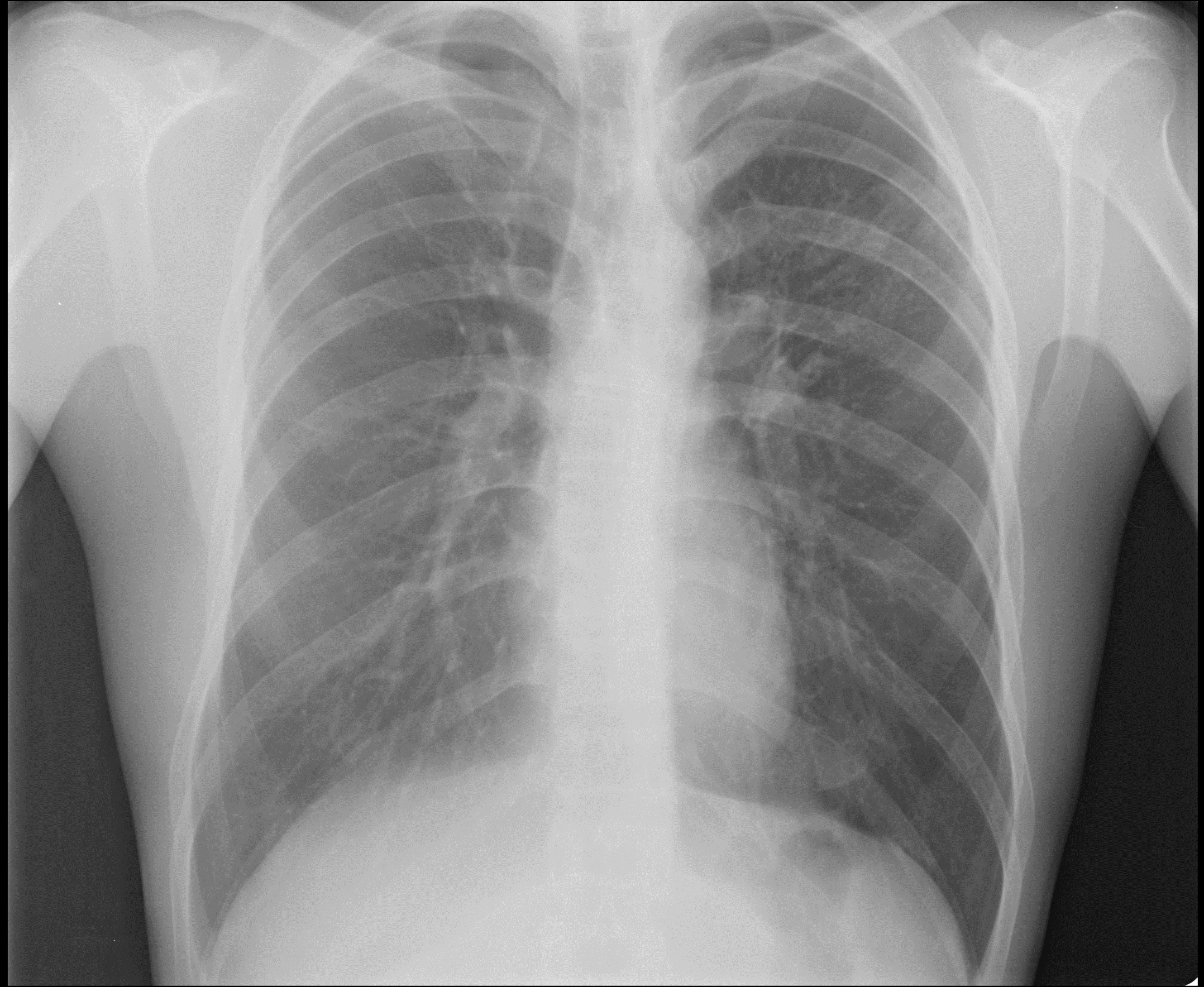 Пневмонии на рентгене у взрослых фото