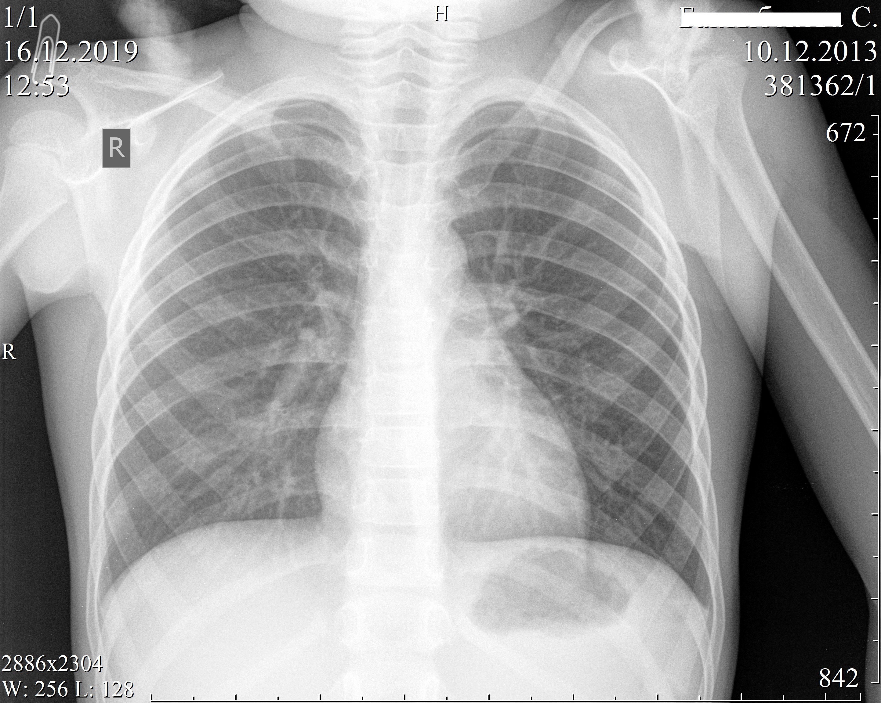 Рентгенография грудной клетки пневмония