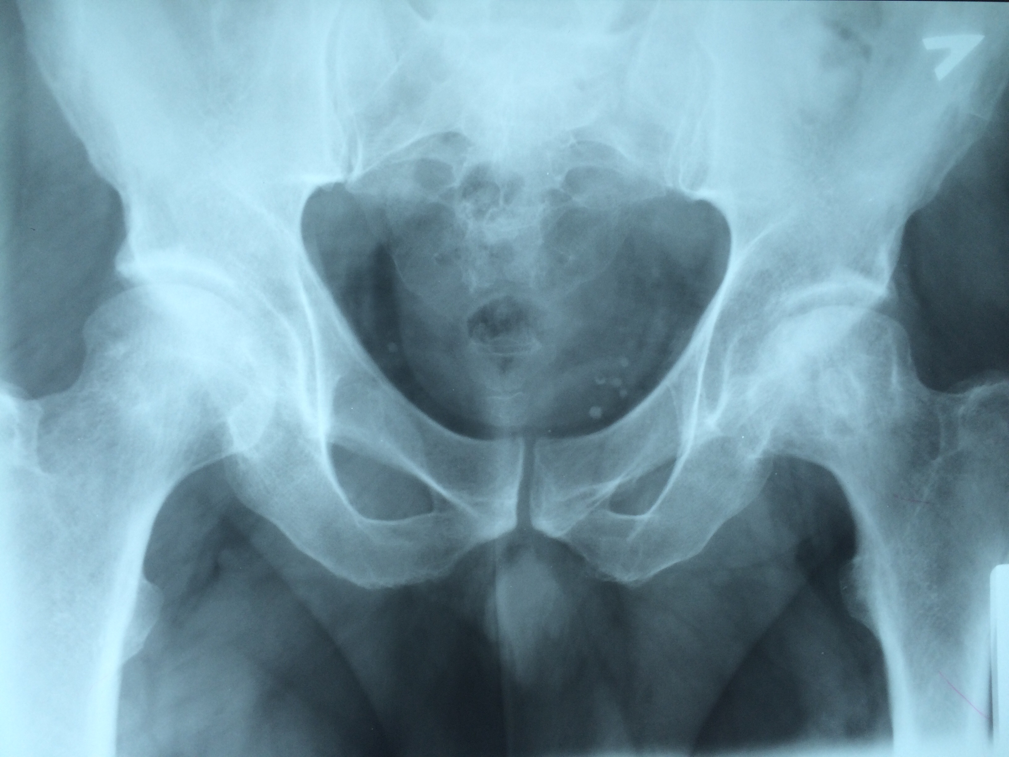 Диспластический артроз тазобедренного сустава рентген