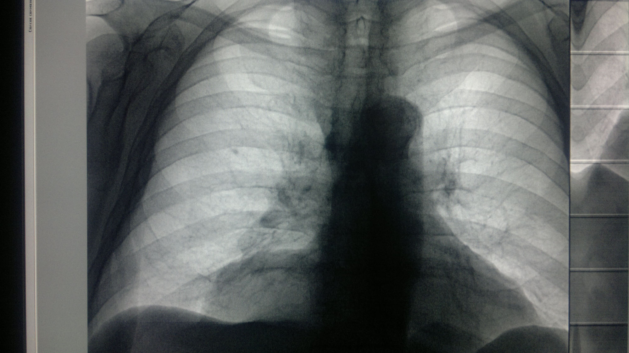 Липома кардиодиафрагмального угла справа