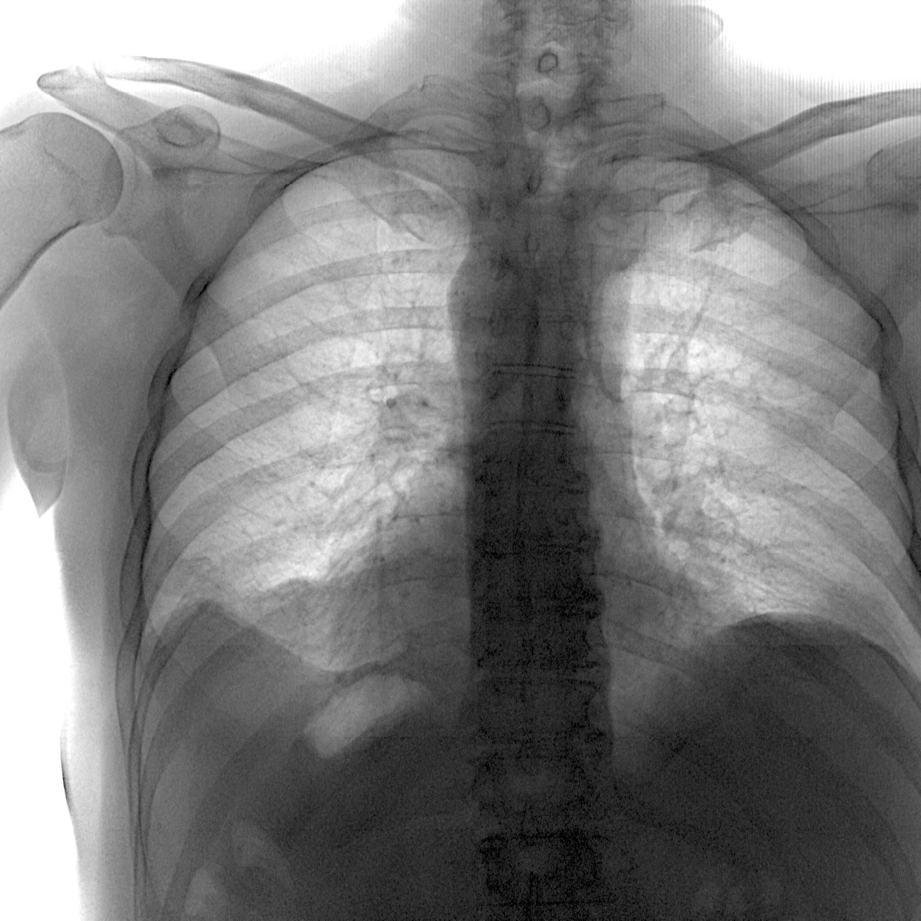Задняя проекция грудной клетки рентген