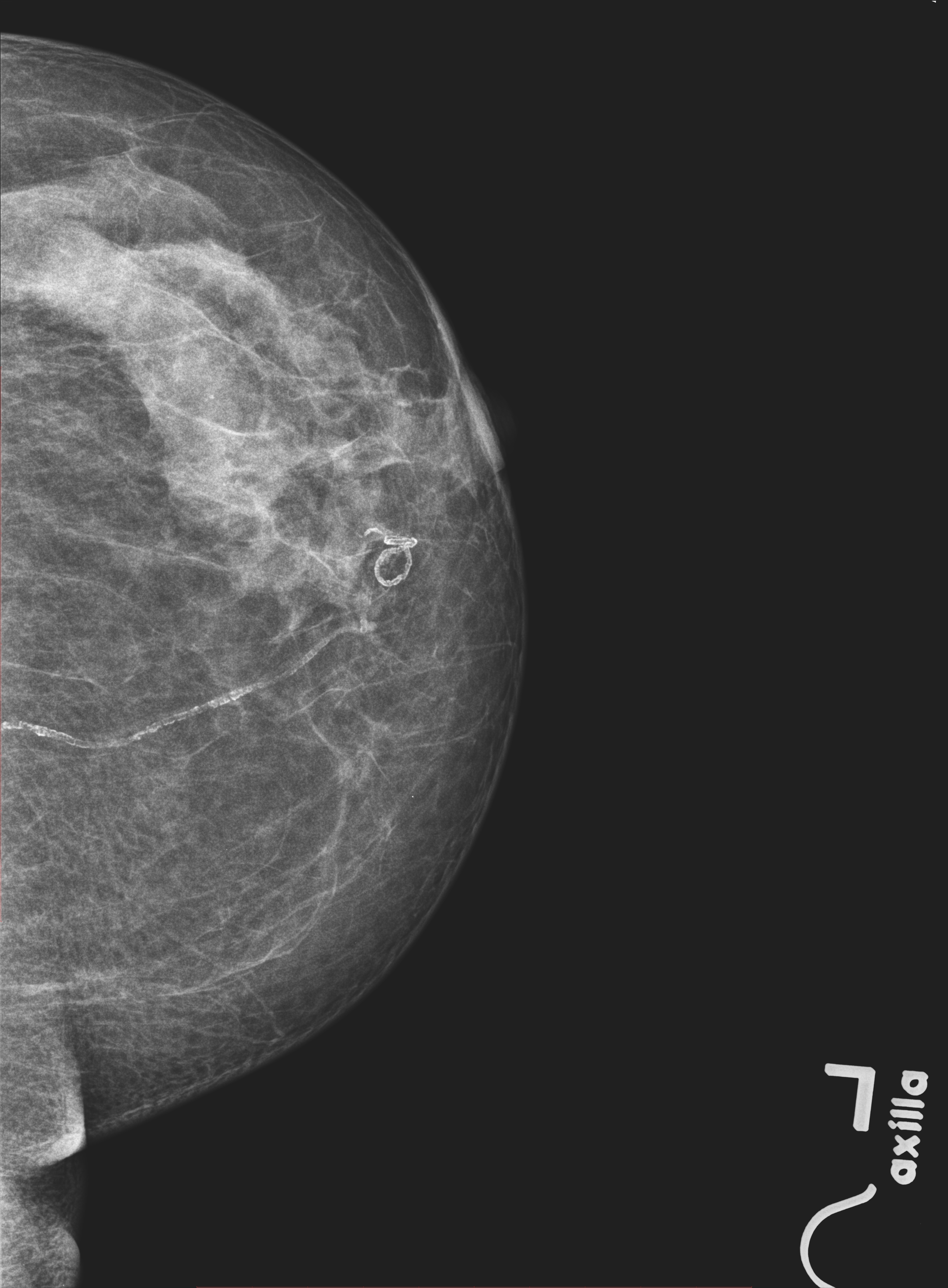 что такое маммография молочных желез фото