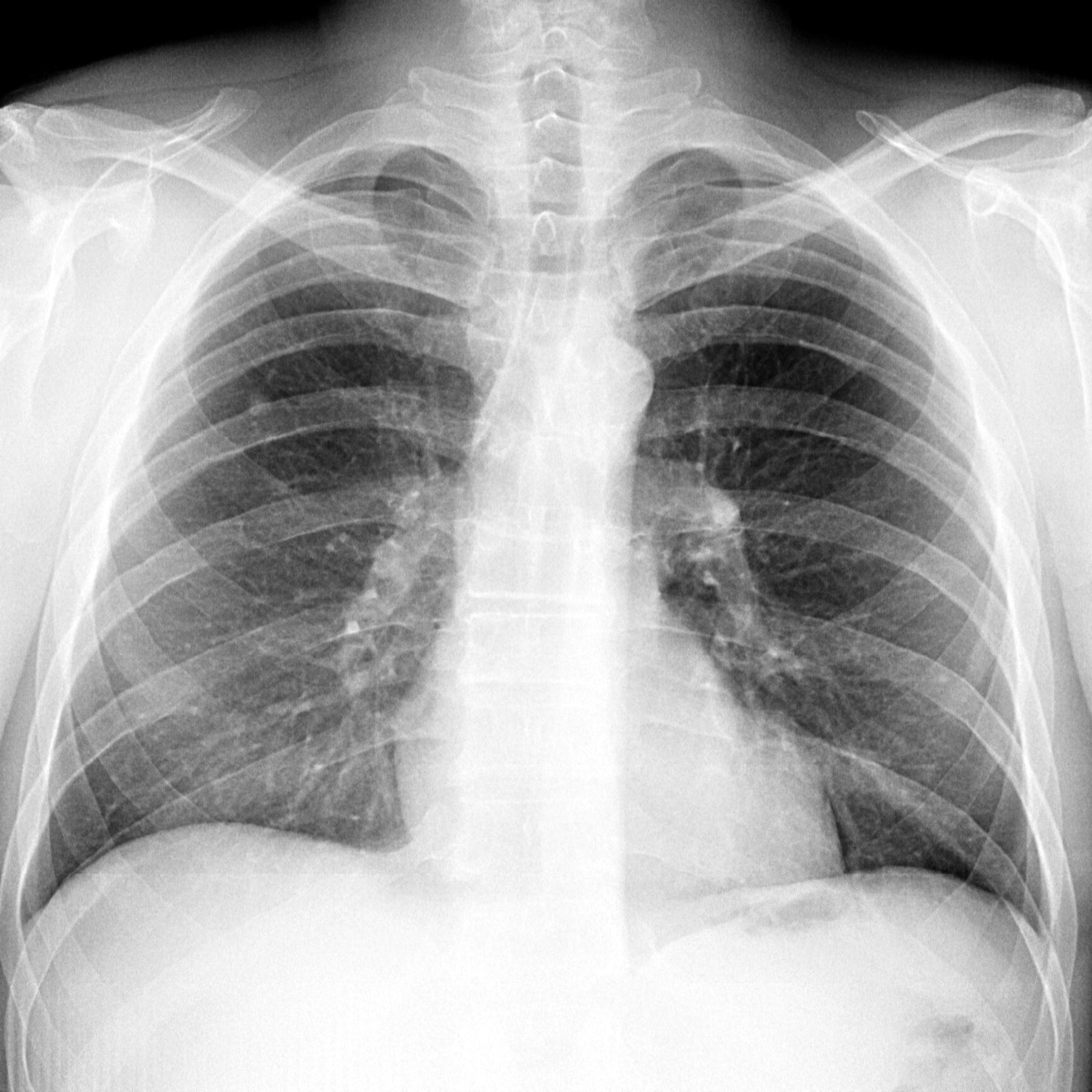 Снимок. Туберкулёма лёгких рентгенограмма. Туберкулома на флюорографии. Рентгенограмма ОГК норма. Флюорография снимок туберкулема.