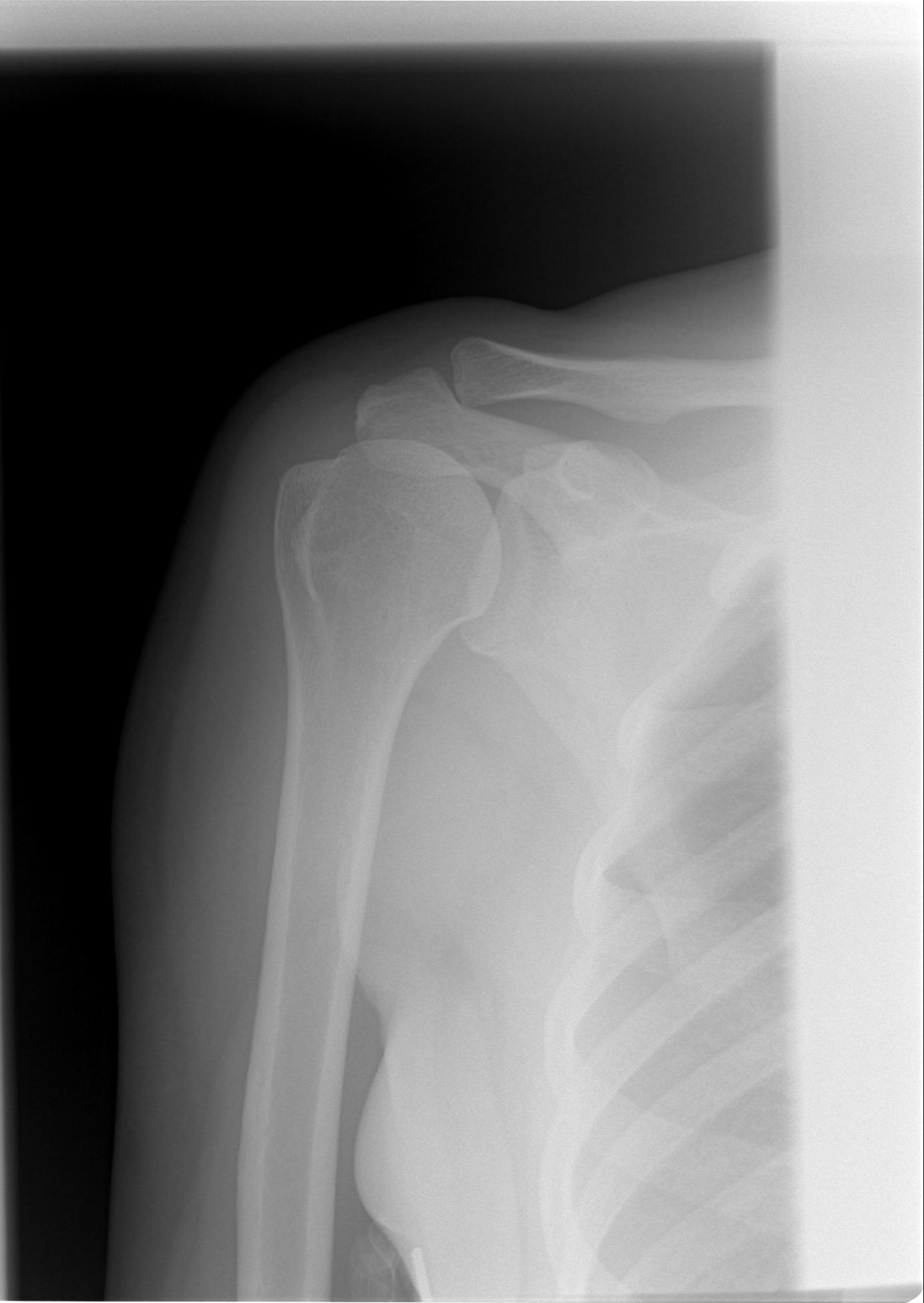 Диагноз доа суставов. Энхондрома левой плечевой кости. Энхондрома плечевой кости рентген. Обызвествления в плечевом суставе.