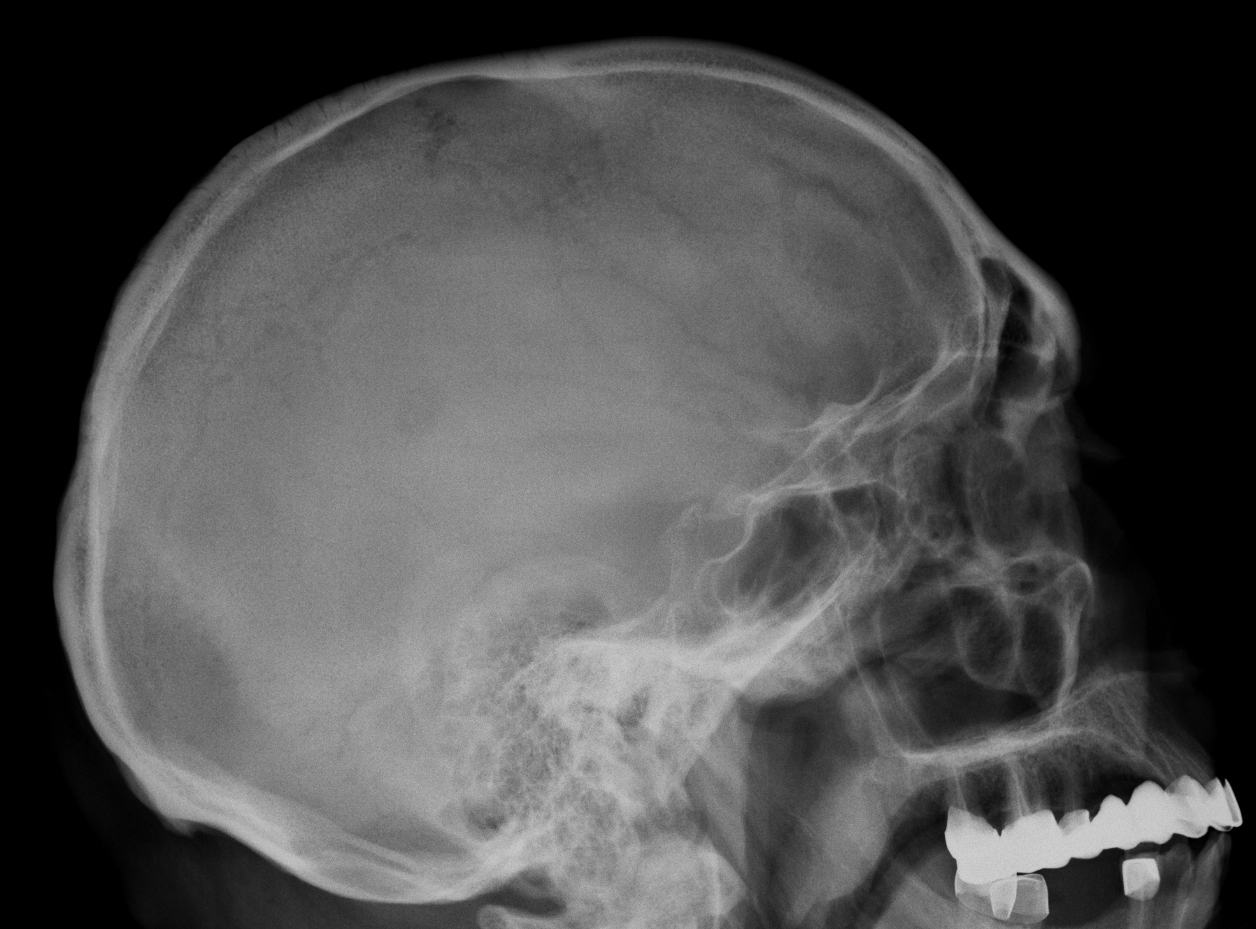 Сотрясение черепа. Перелом теменной кости черепа рентген. Перелом теменной кости рентген. Рентген черепа субдуральная гематома.