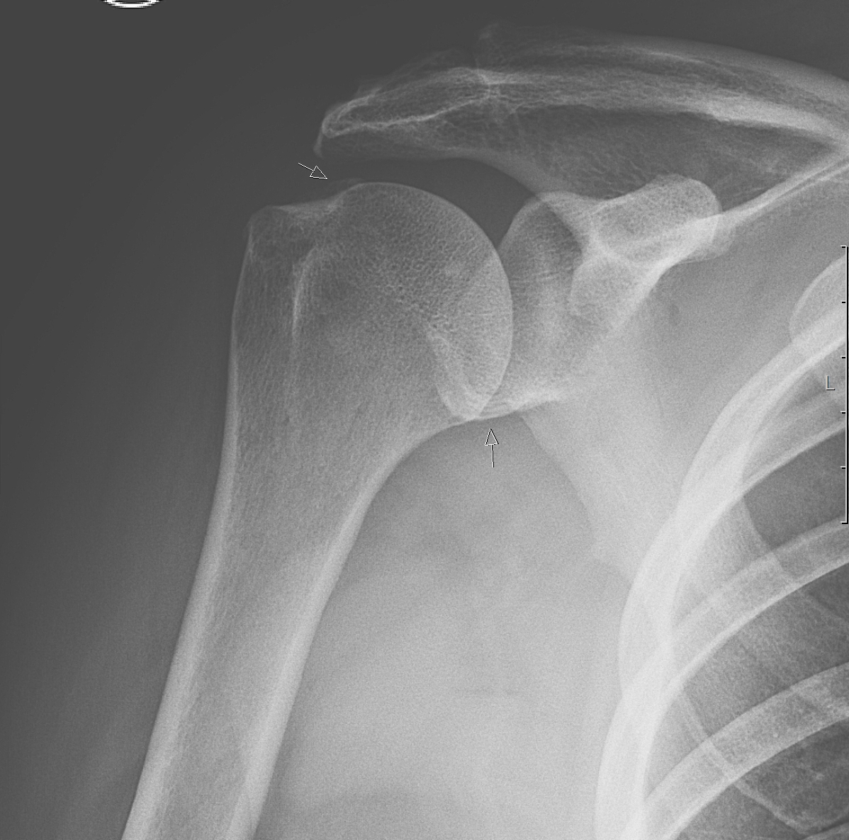Вывих плечевого сустава рентген