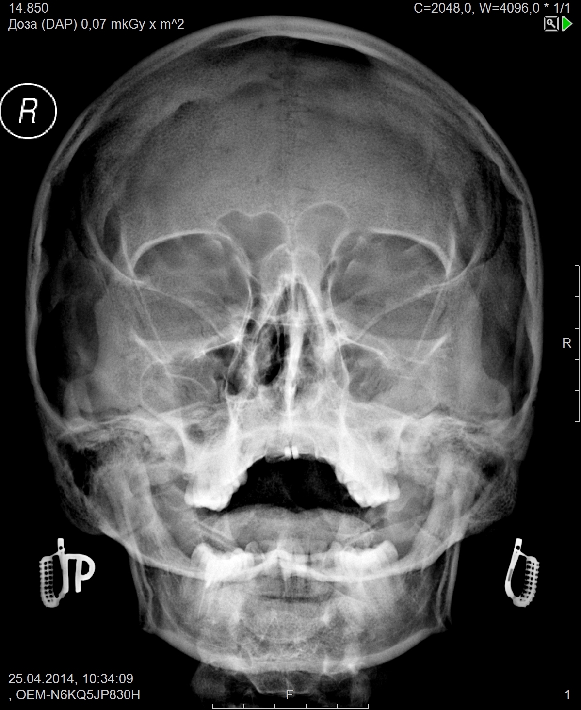 Рентген ппн. Перелом верхнечелюстной пазухи рентген. Кт черепа придаточные пазухи. Верхнечелюстная пазуха рентген анатомия.