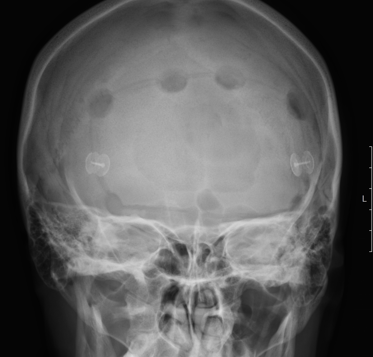 Сотрясение кости. Вдавленный перелом лобной кости рентген. Перелом теменной кости черепа рентген. Оскольчатый перелом черепа рентген. Перелом лобной кости рентген снимок.