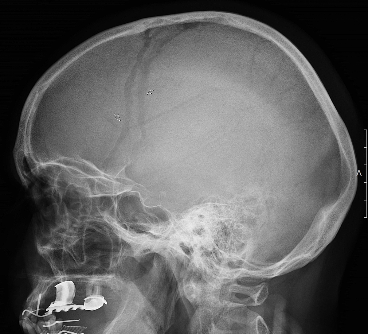 Снимок черепа. Сосудистые борозды черепа. Сосудистые борозды черепа на рентгенограмме. Коронарная снимок черепа.