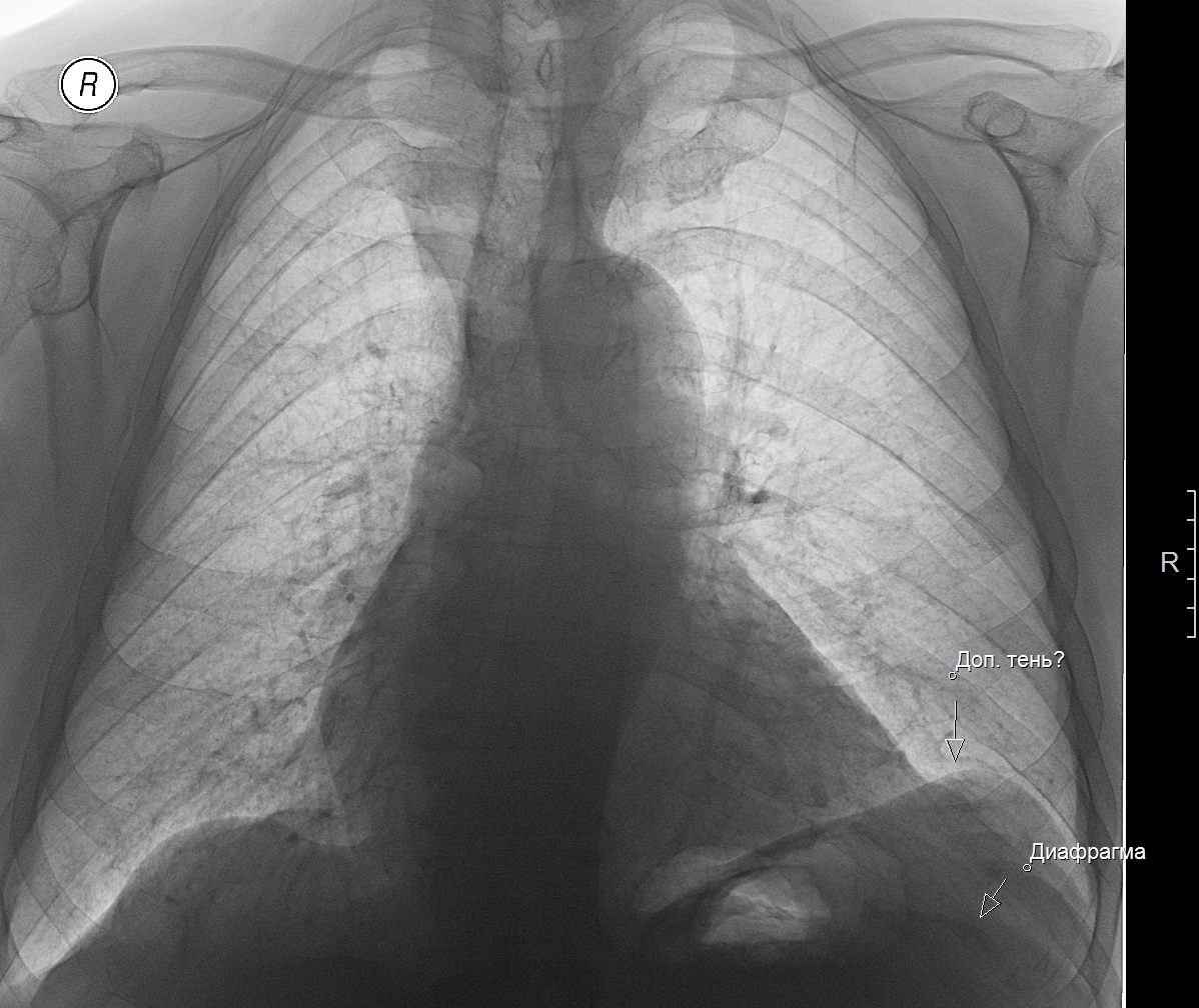 Купол диафрагмы. Парез диафрагмы на рентгене. Куполы диафрагмы рентген. Парез купола диафрагмы. Купол диафрагмы на рентгенограмме.